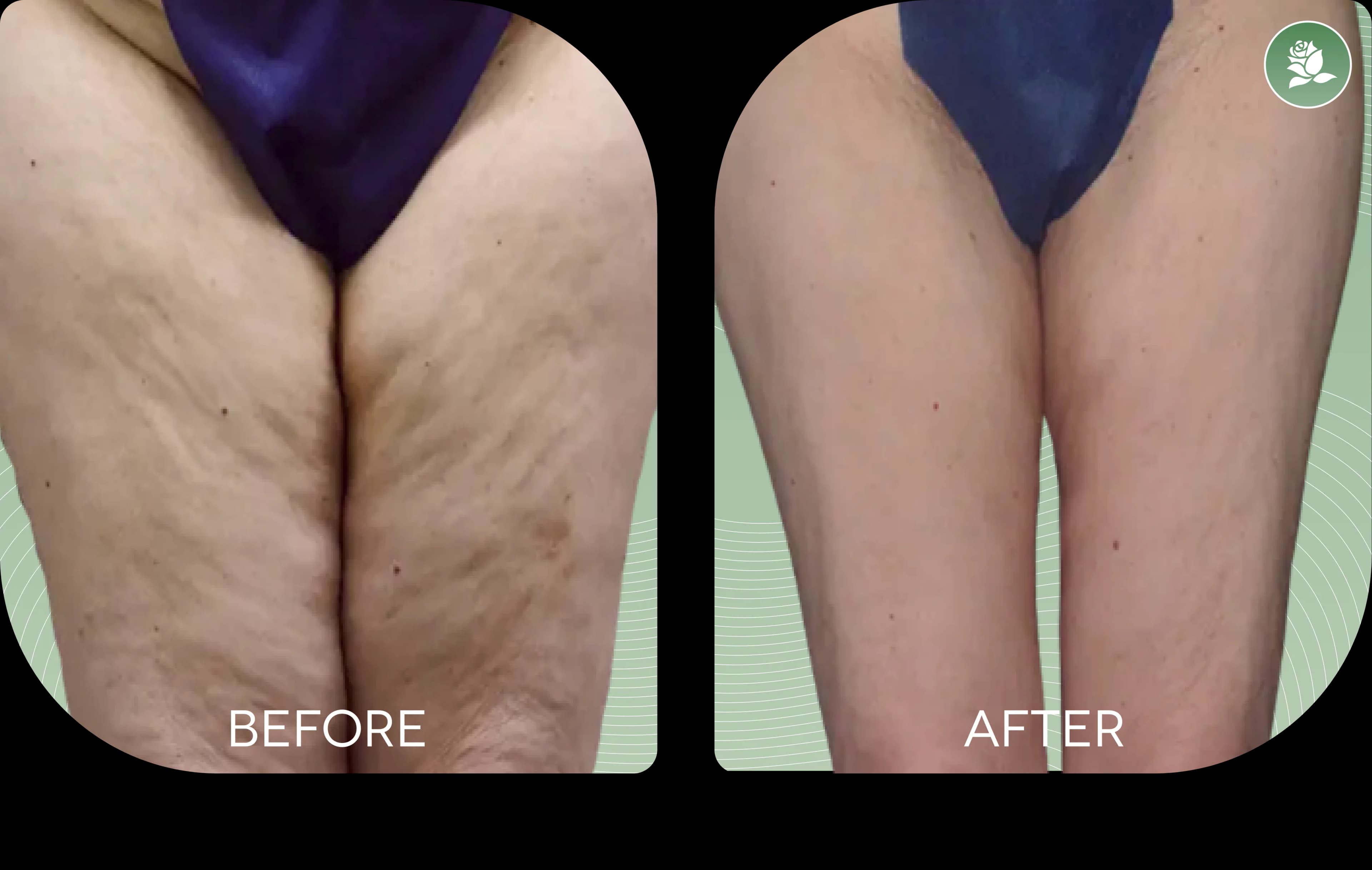 Stephanie A. before and after body contouring treatment