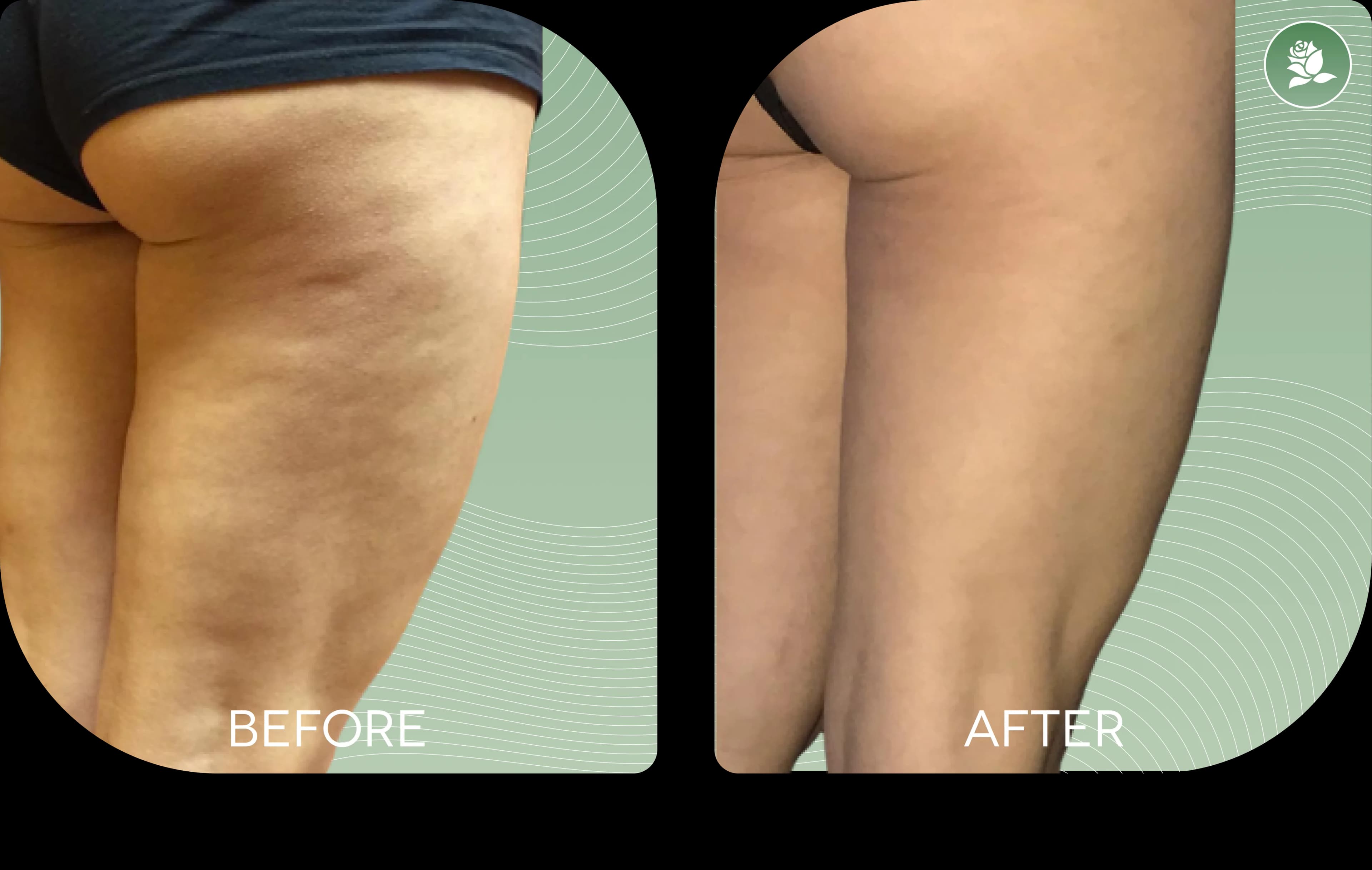 MICHELLE SCERRI before and after body contouring treatment