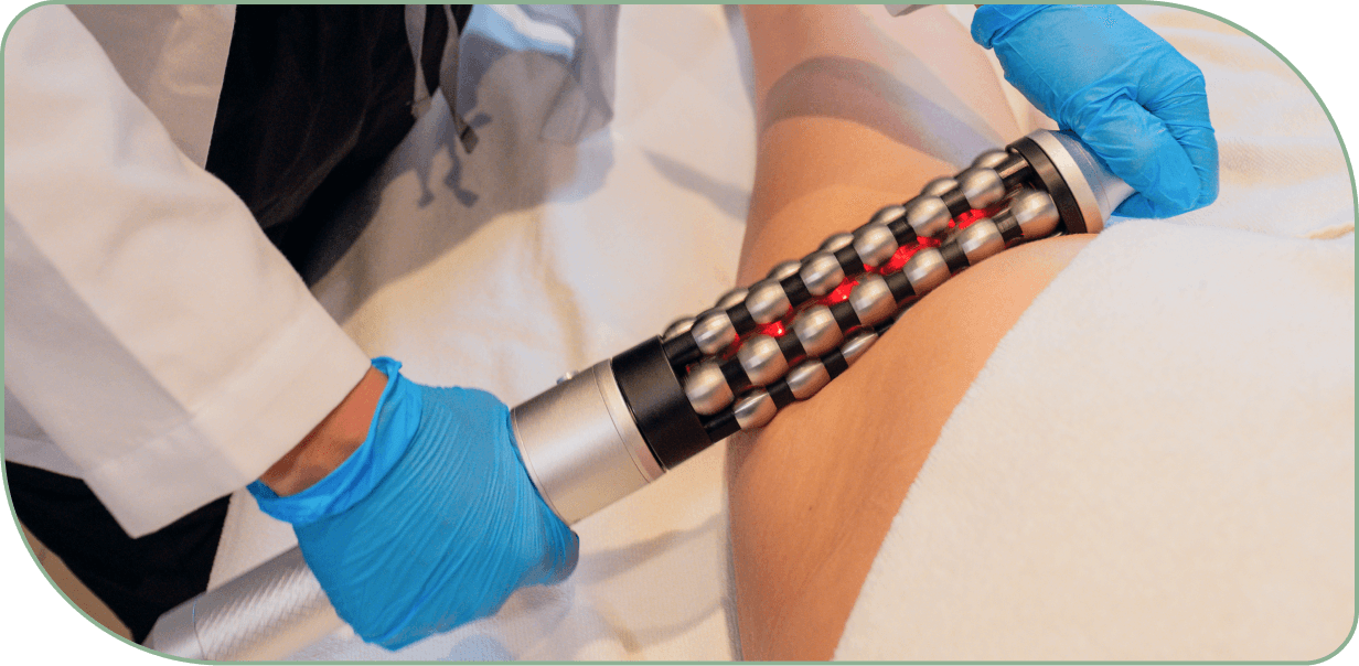 velashape technology for cellulite appearance evidence illustration