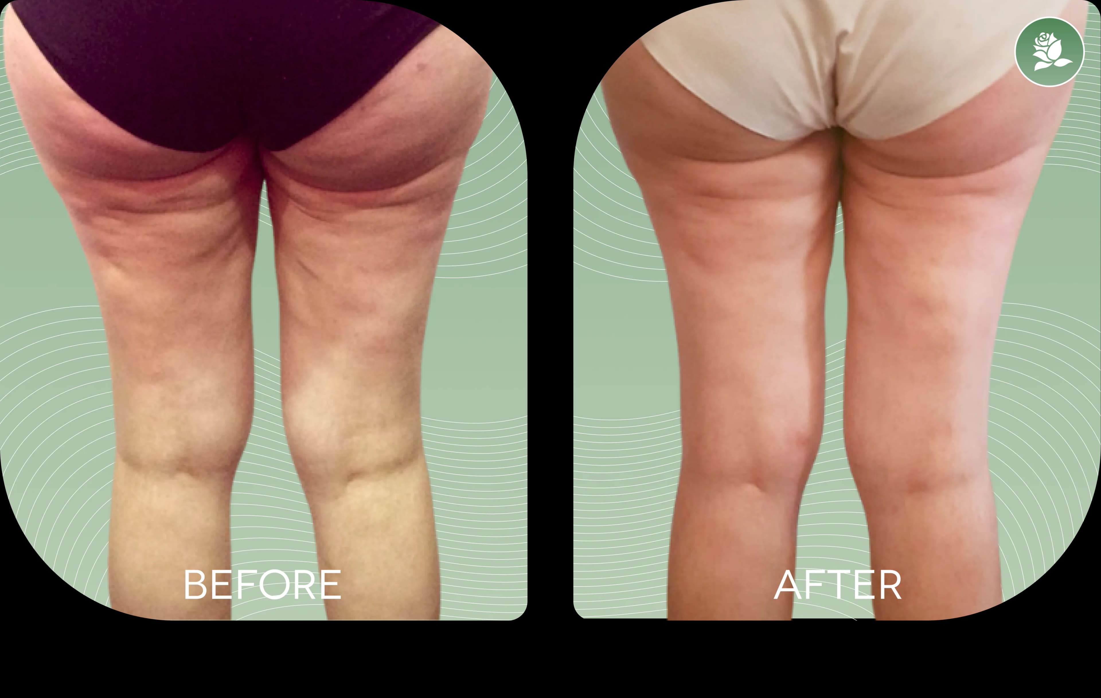 Francesca M. before and after body contouring treatment