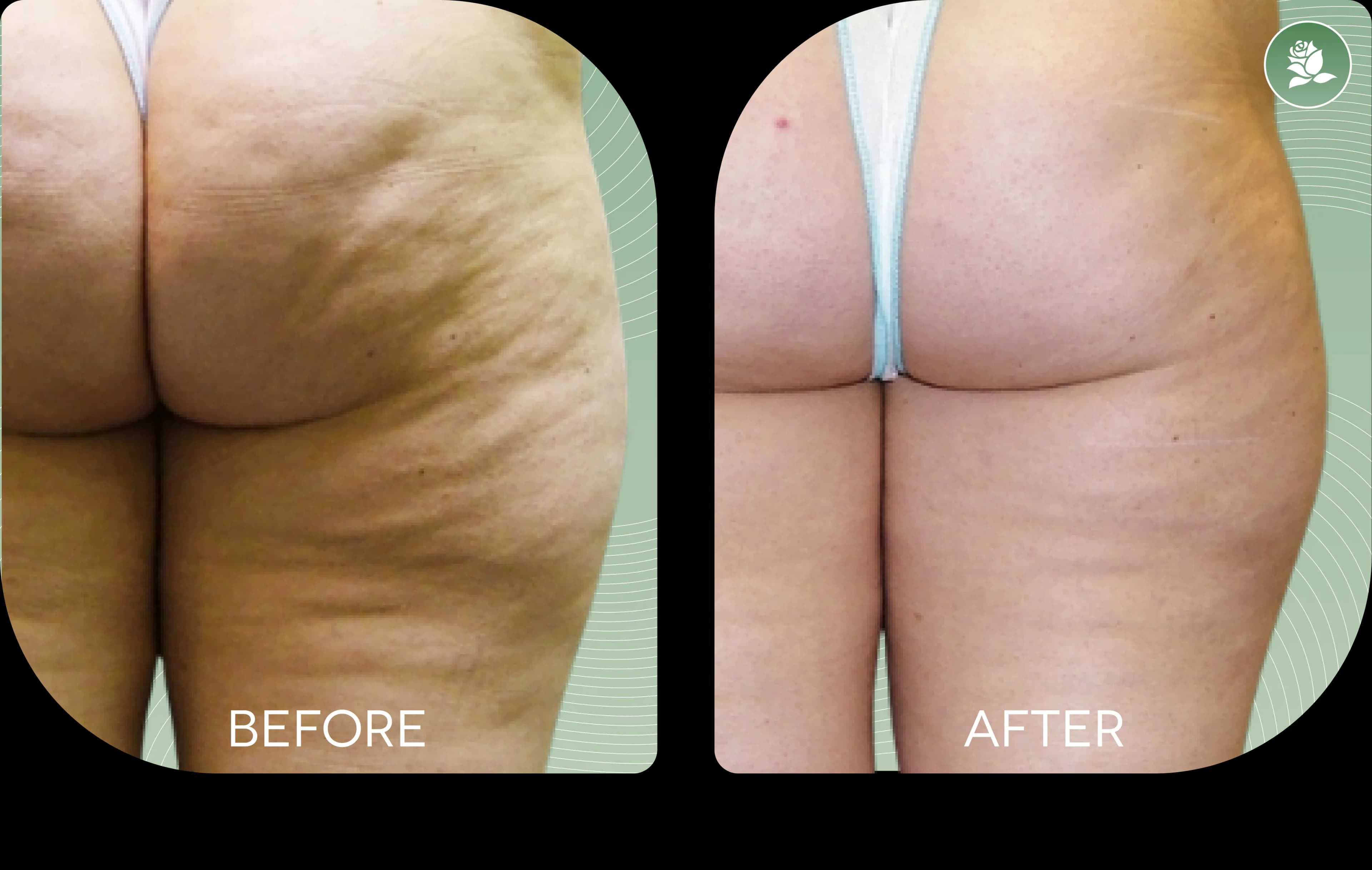 JULIA BECKER before and after body contouring treatment