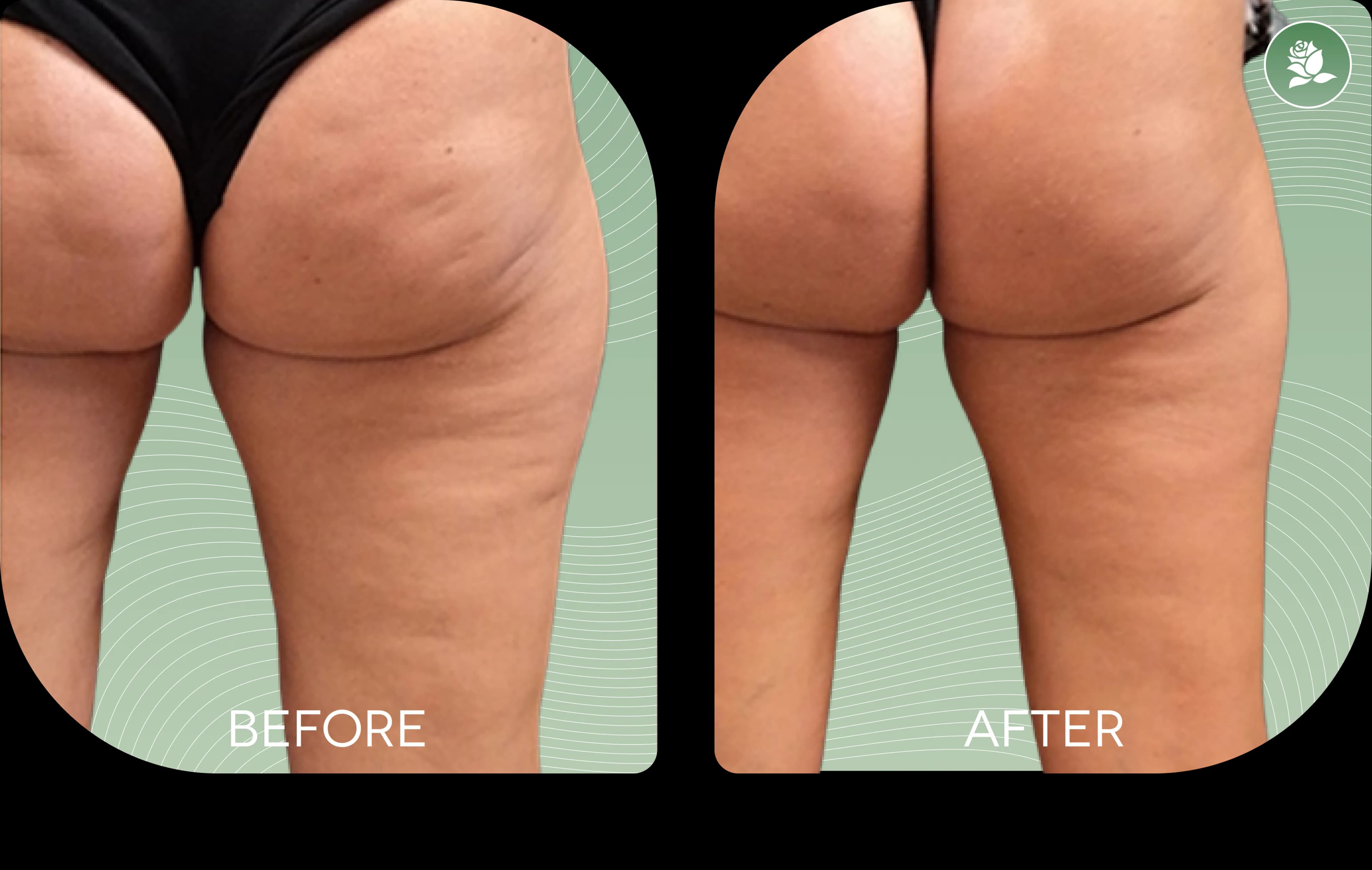 FRANCESCA BIANCHI before and after body contouring treatment