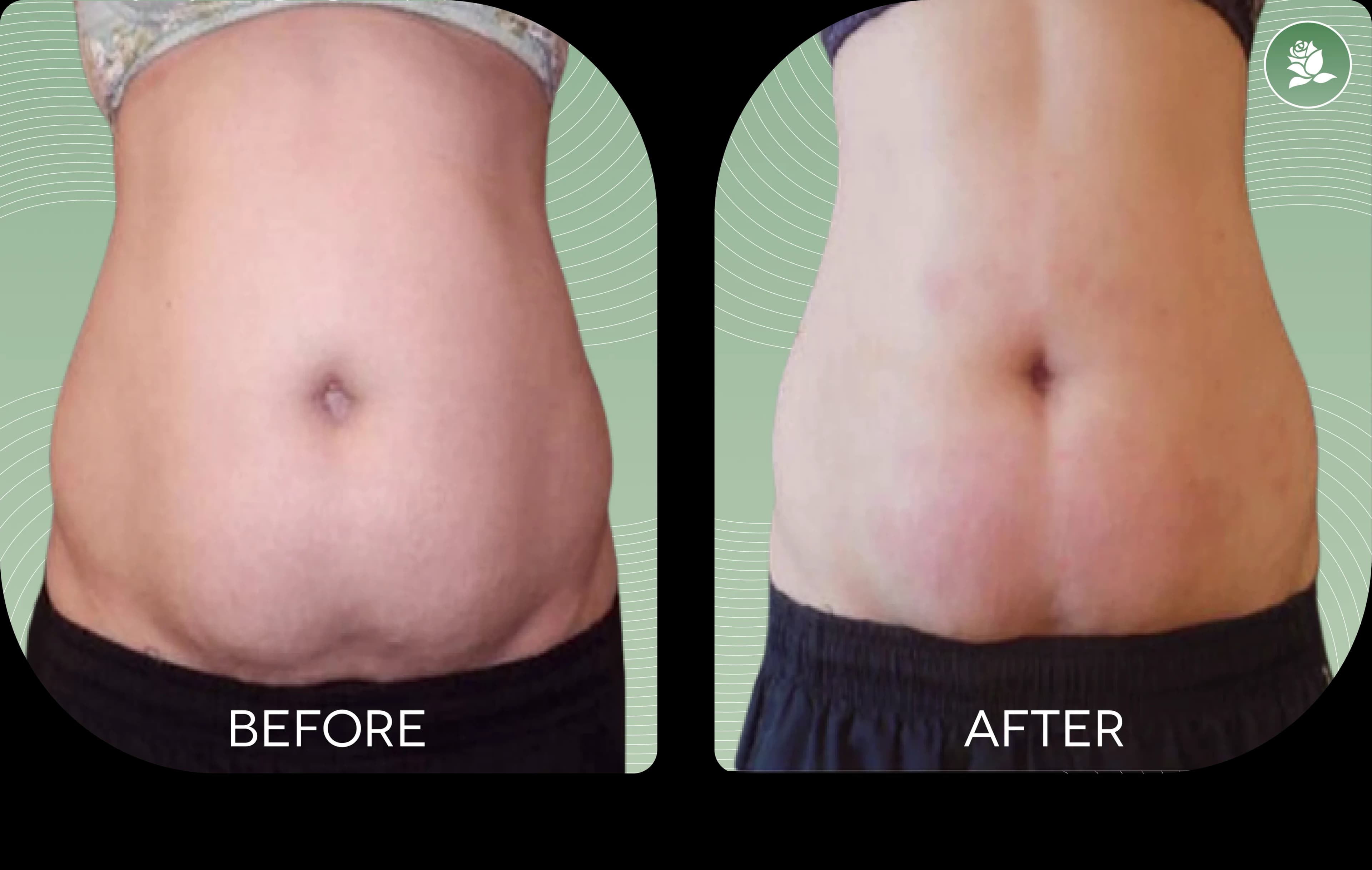 Maria B. before and after body contouring treatment