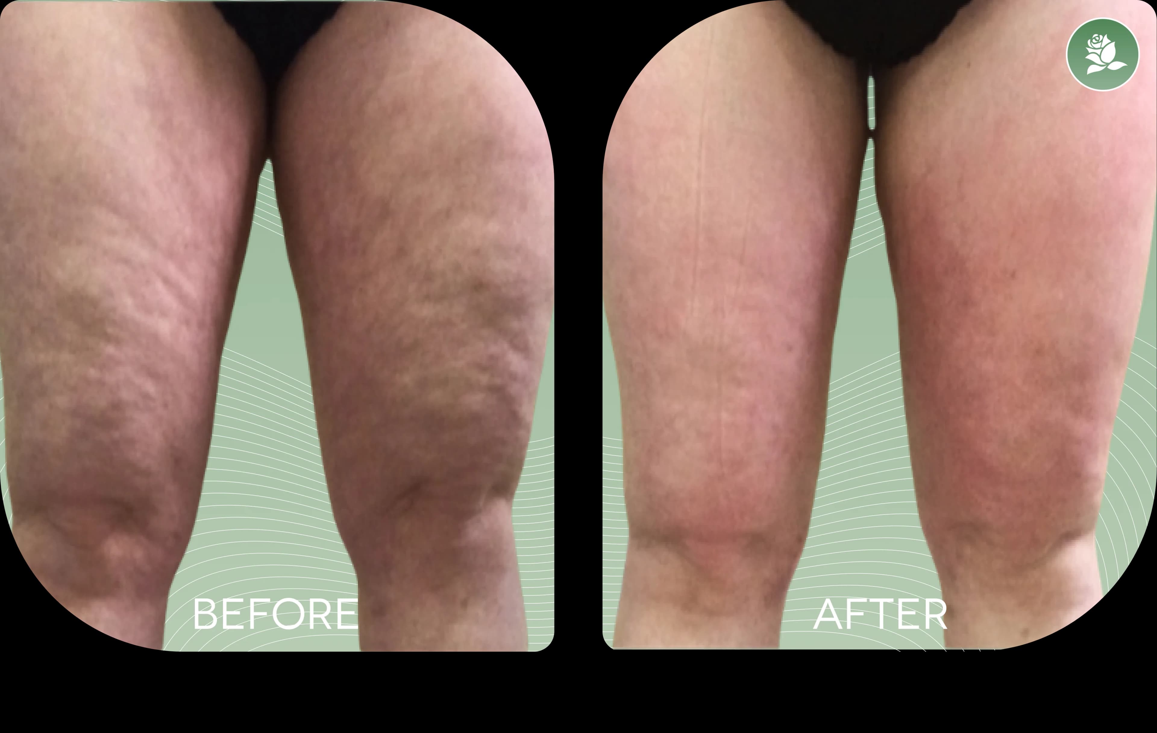 LORRAINE VELLA before and after body contouring treatment
