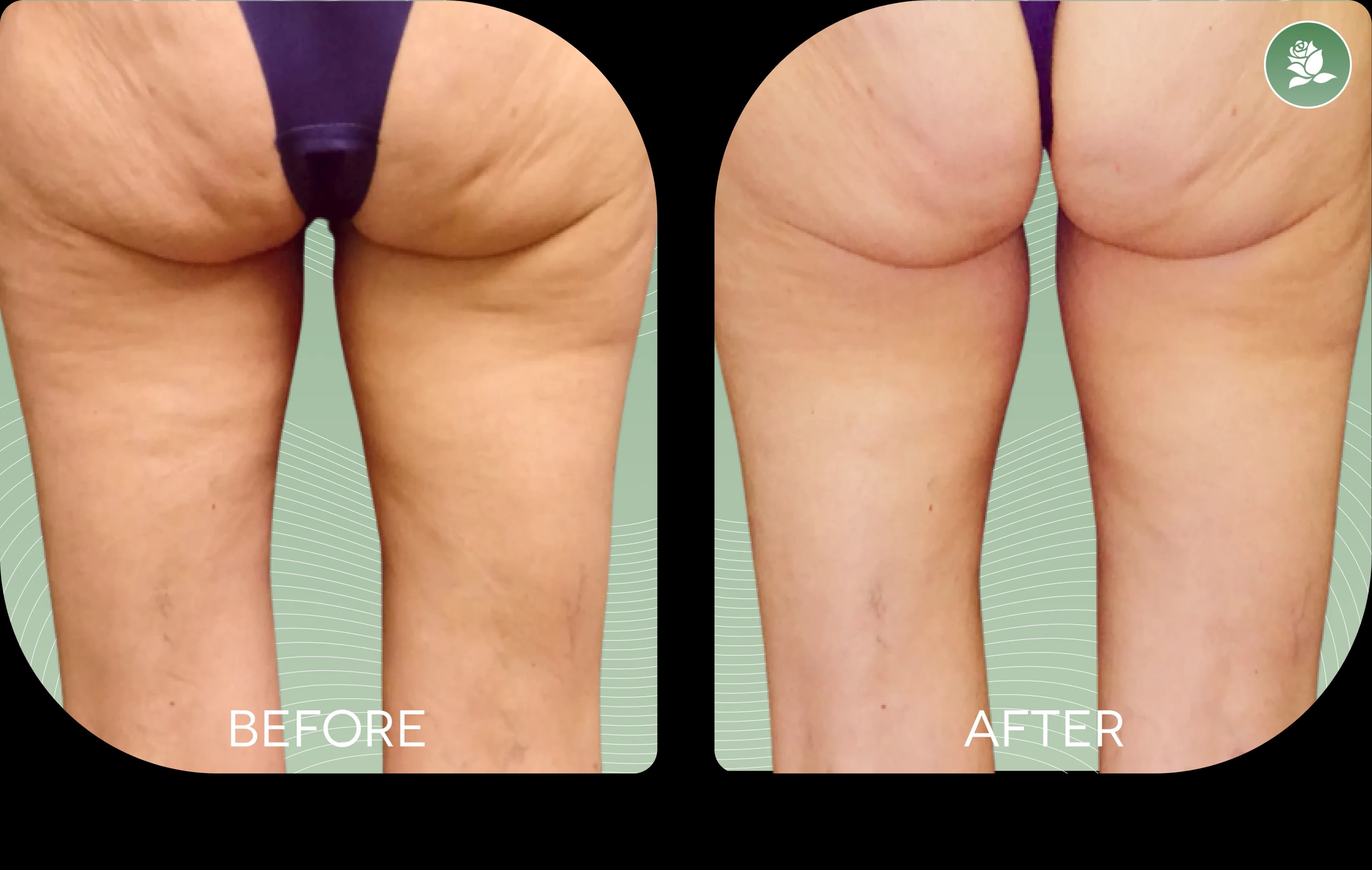 Daniela C. before and after body contouring treatment
