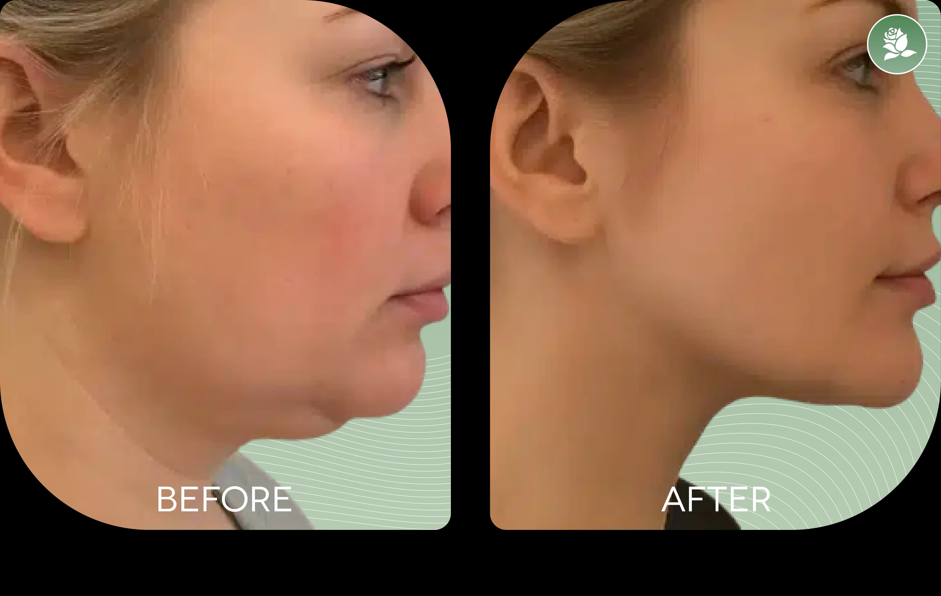 NICOLE ZAMMIT before and after body contouring treatment