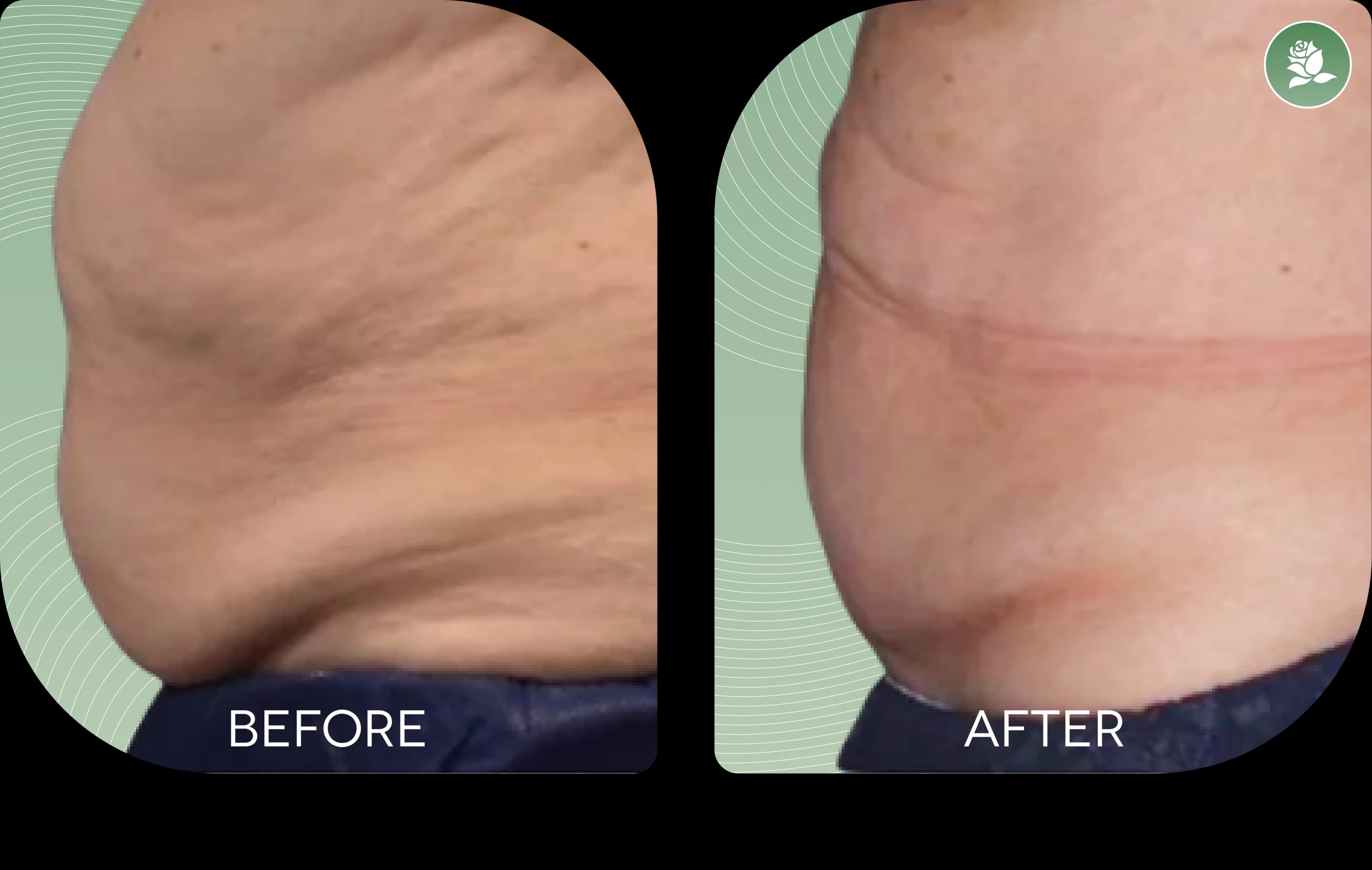 MARK REYNOLDS before and after body contouring treatment