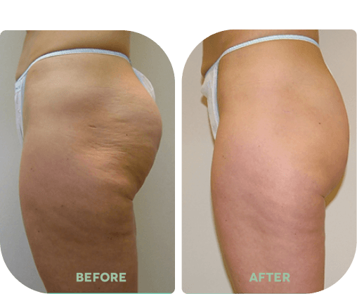 Before and after treatment result