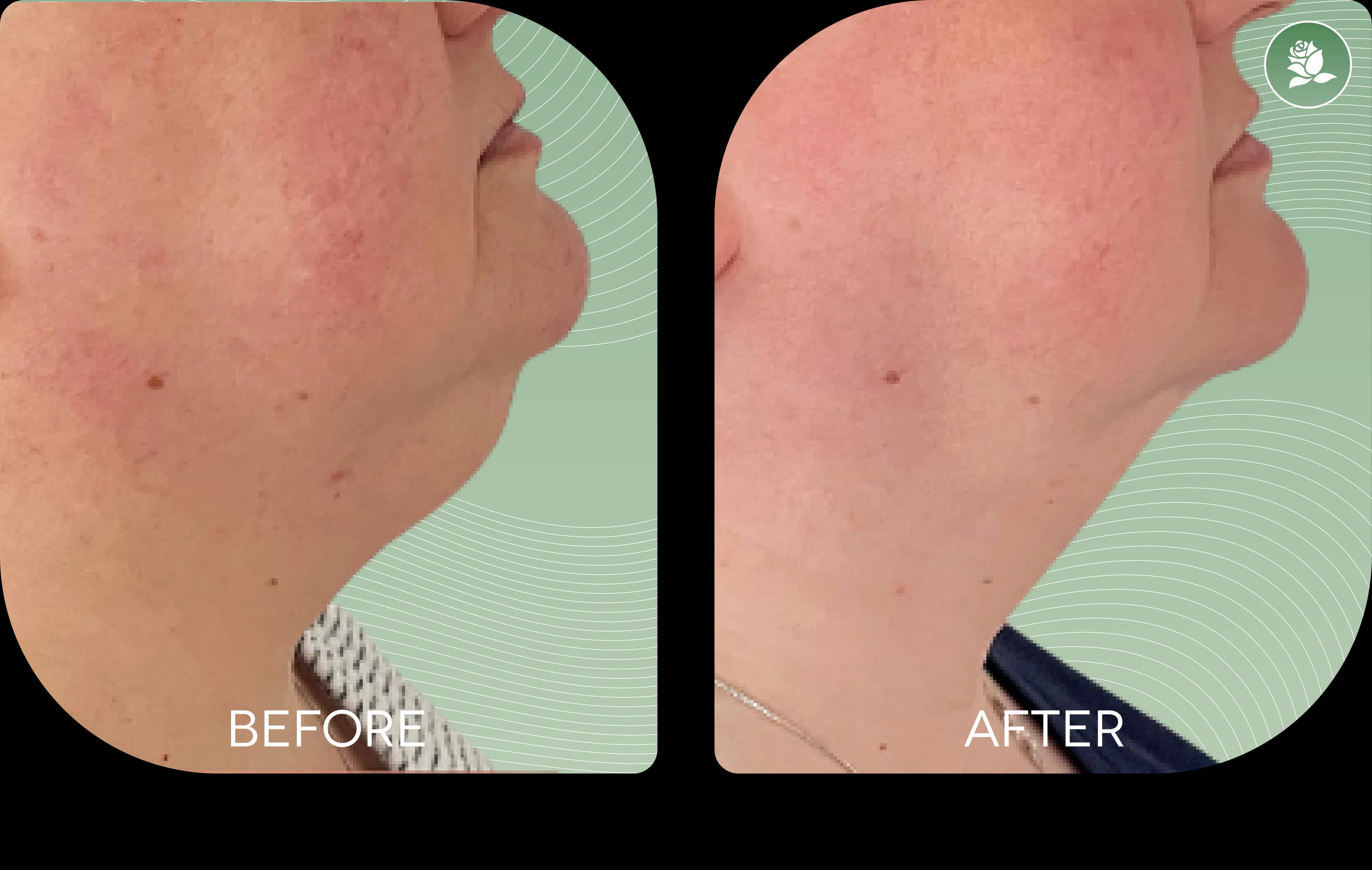 EMMA RICHARD before and after body contouring treatment