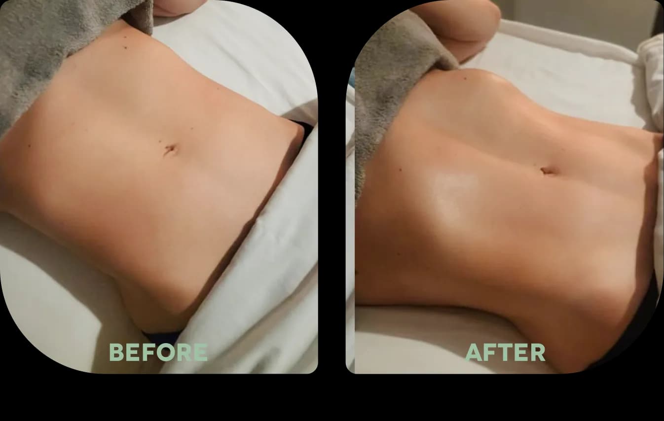 — Dawn Camilleri before and after body contouring treatment