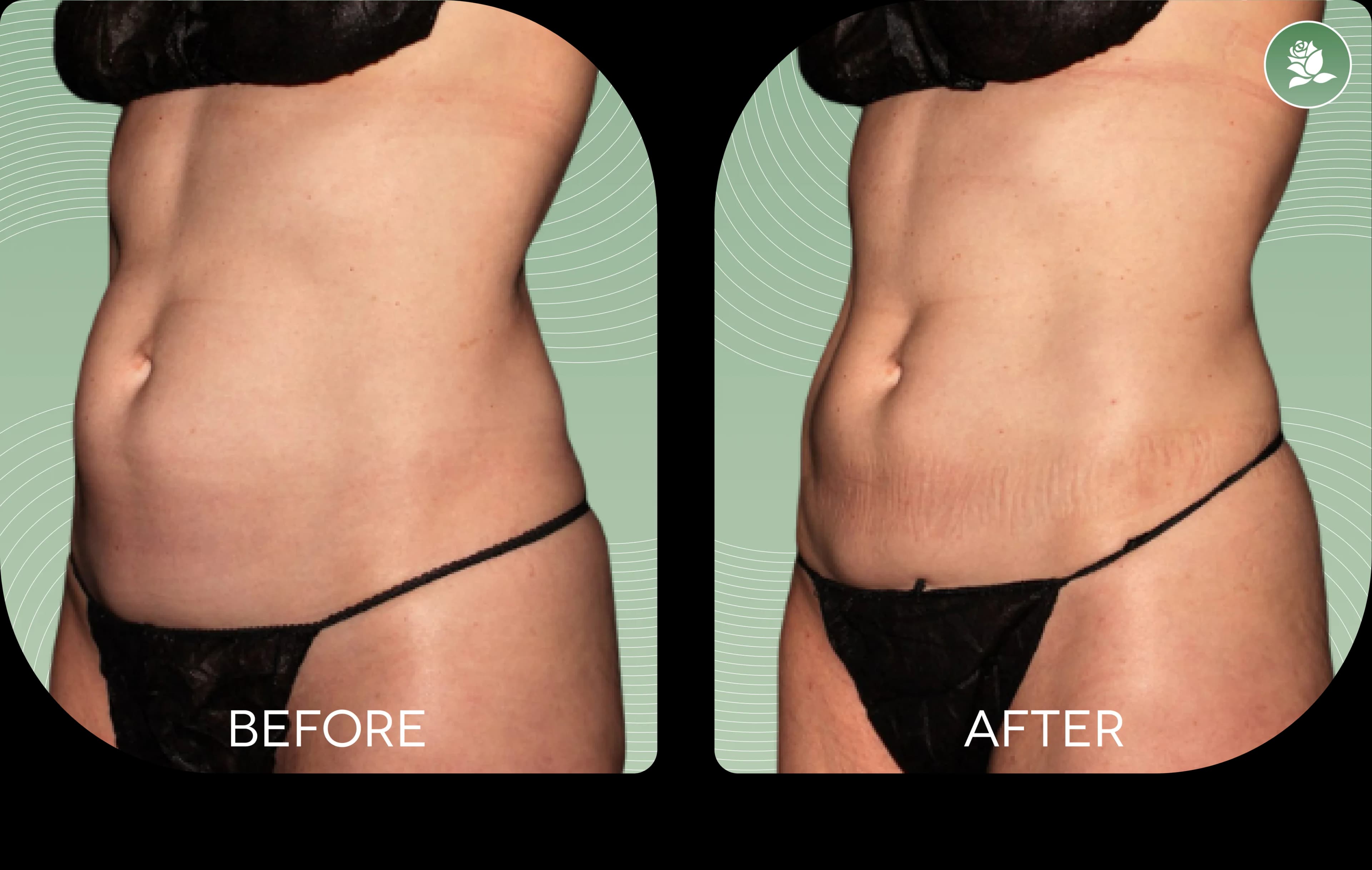 MARIJA CAMILLERI before and after body contouring treatment