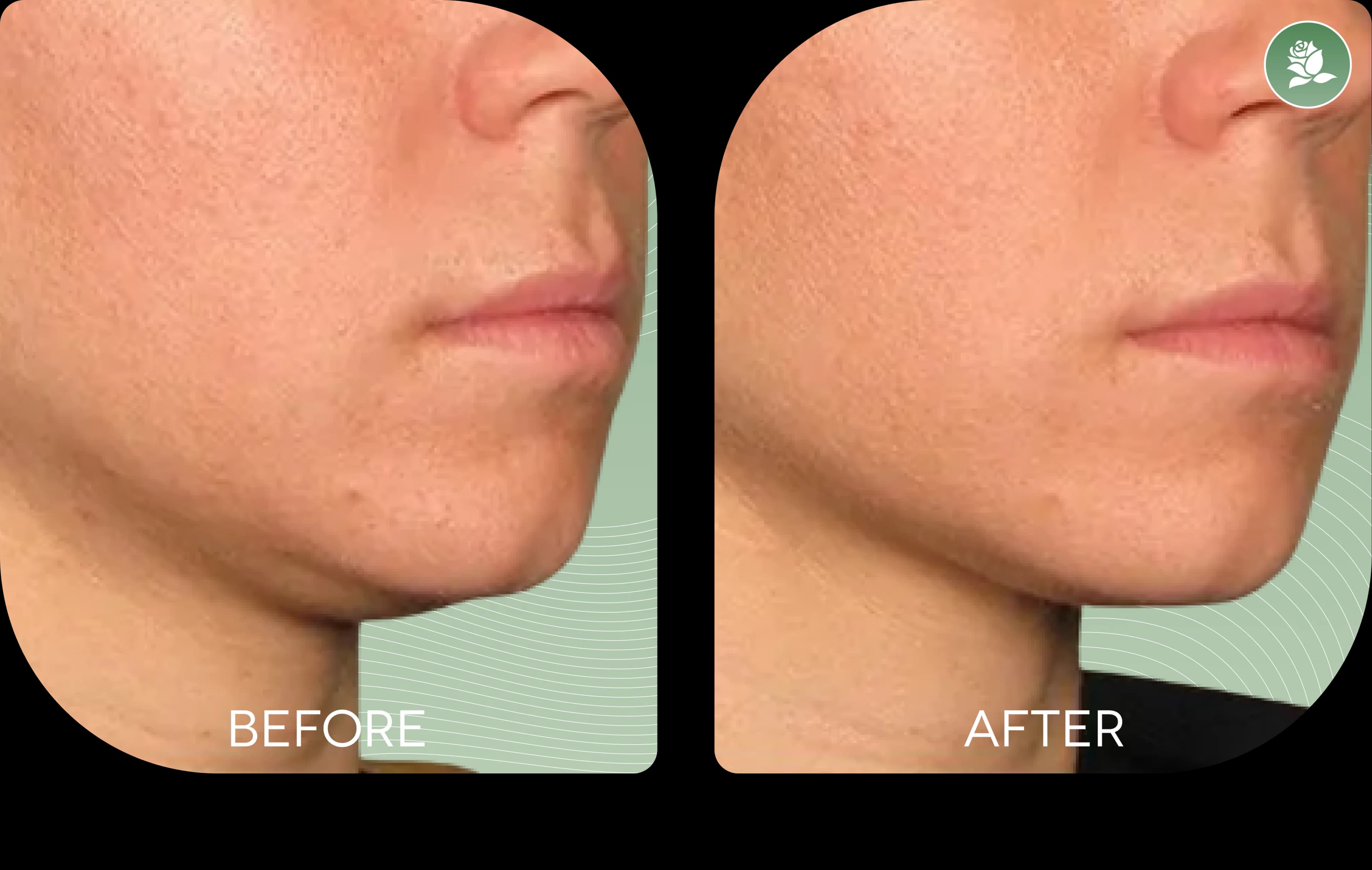 KRISTA MICALLEF before and after body contouring treatment