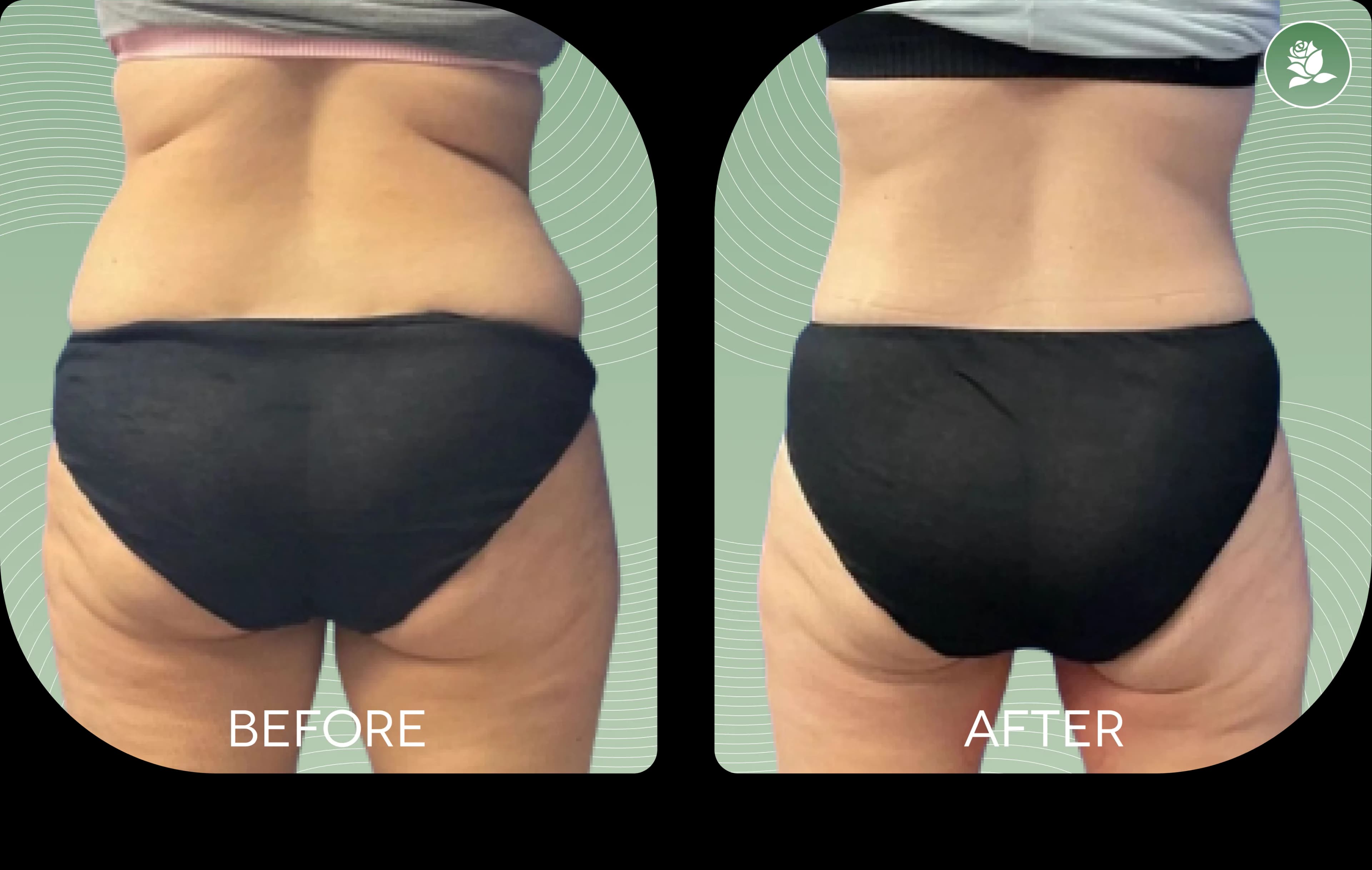 REBECCA ATTARD before and after body contouring treatment