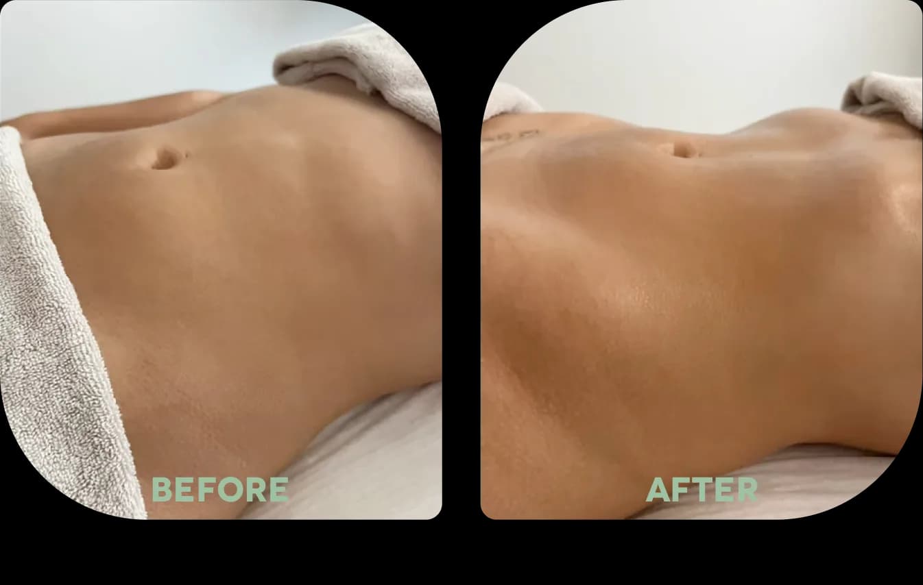 — Pauline Azzopardi before and after body contouring treatment