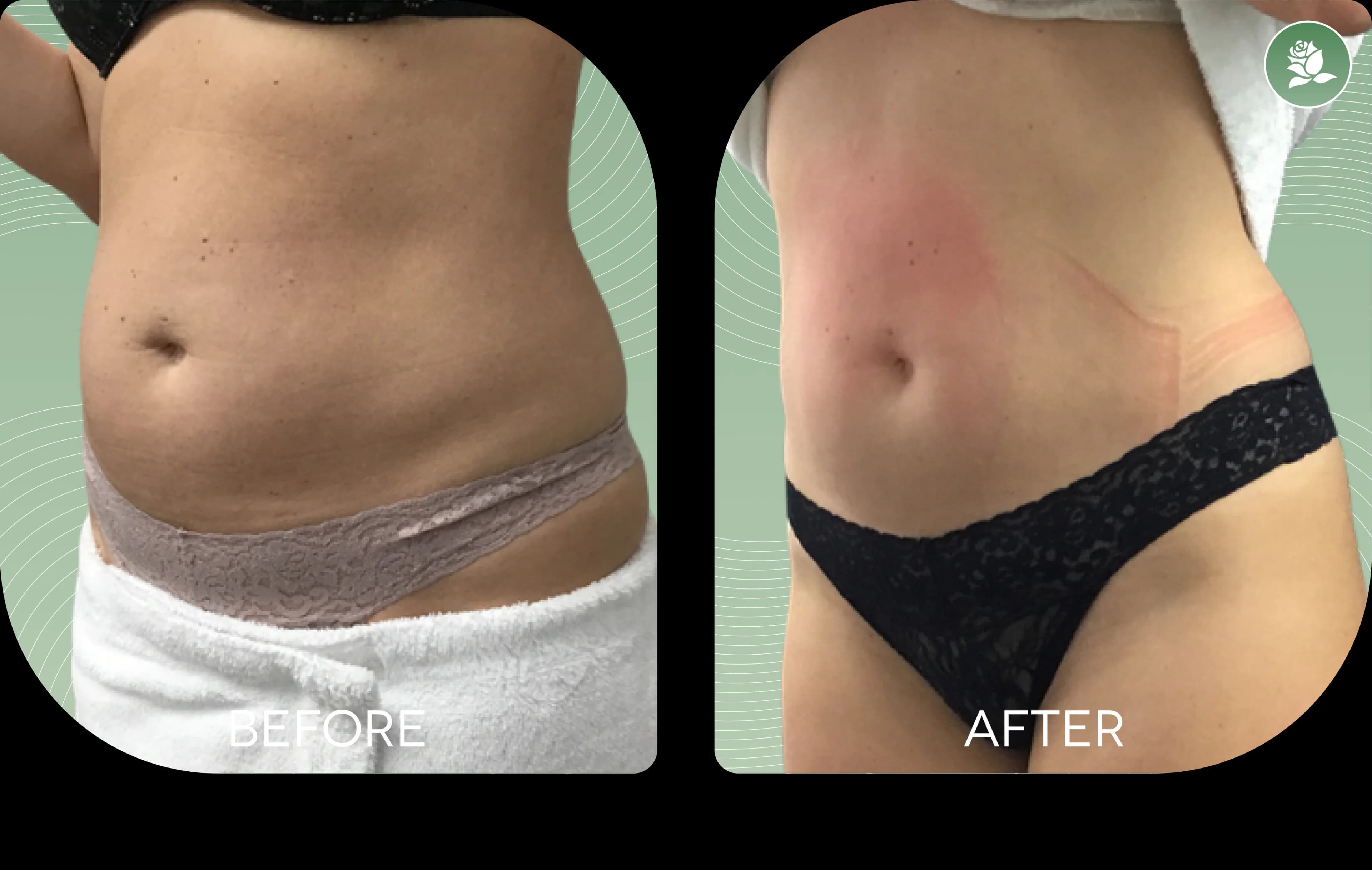 ANDRE VELLA before and after body contouring treatment