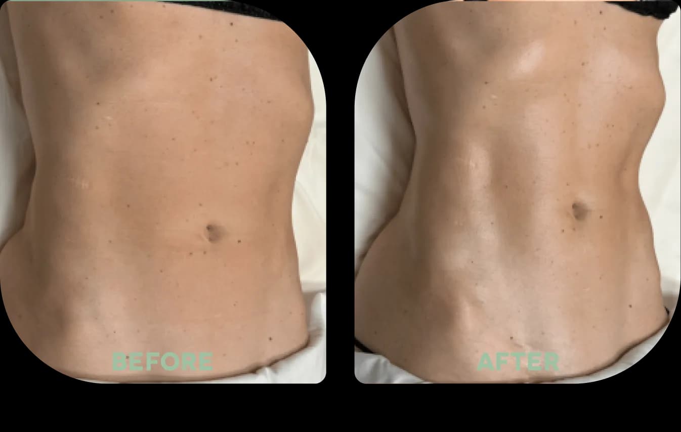 — Lisa van Dijk before and after body contouring treatment