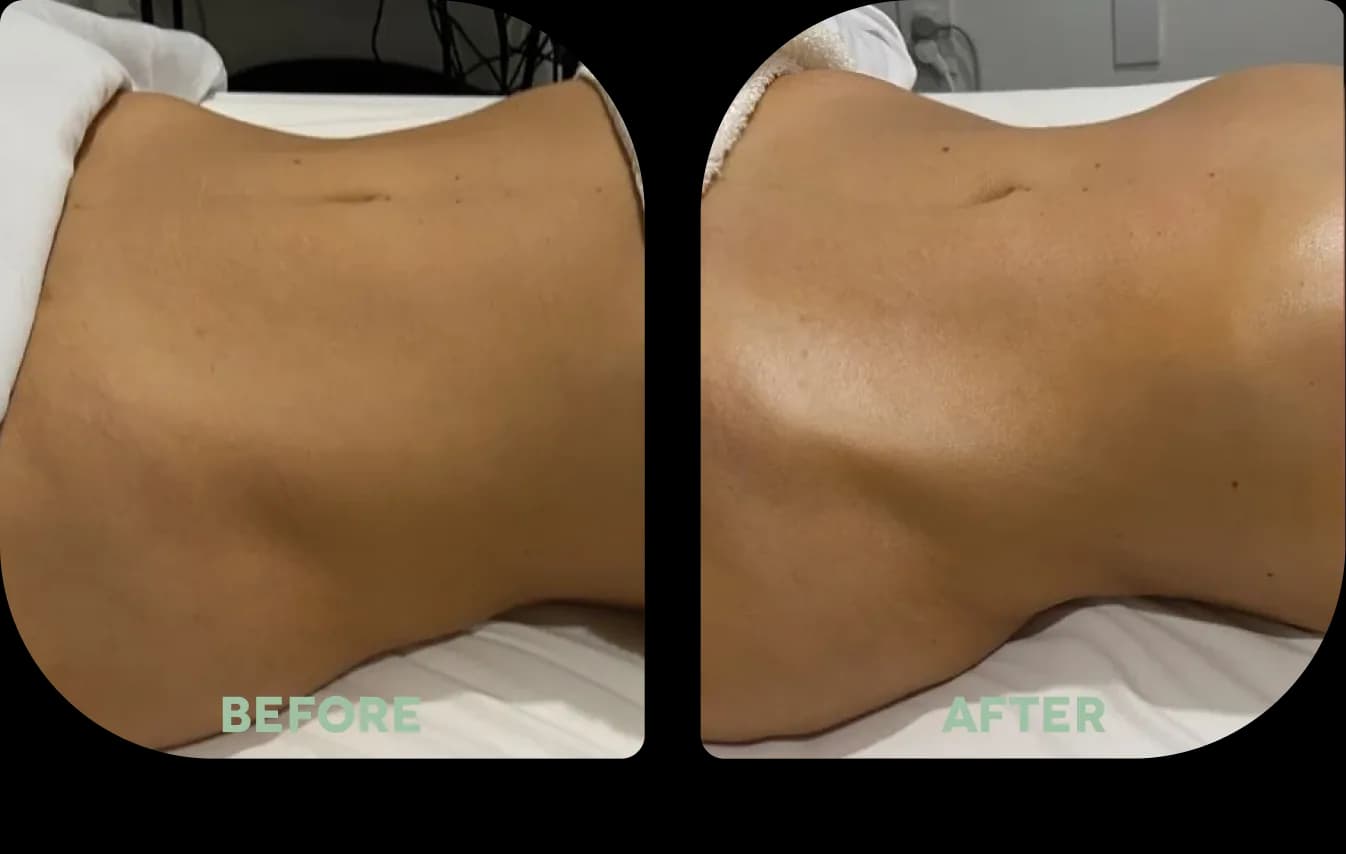 — Emma Nielsen before and after body contouring treatment