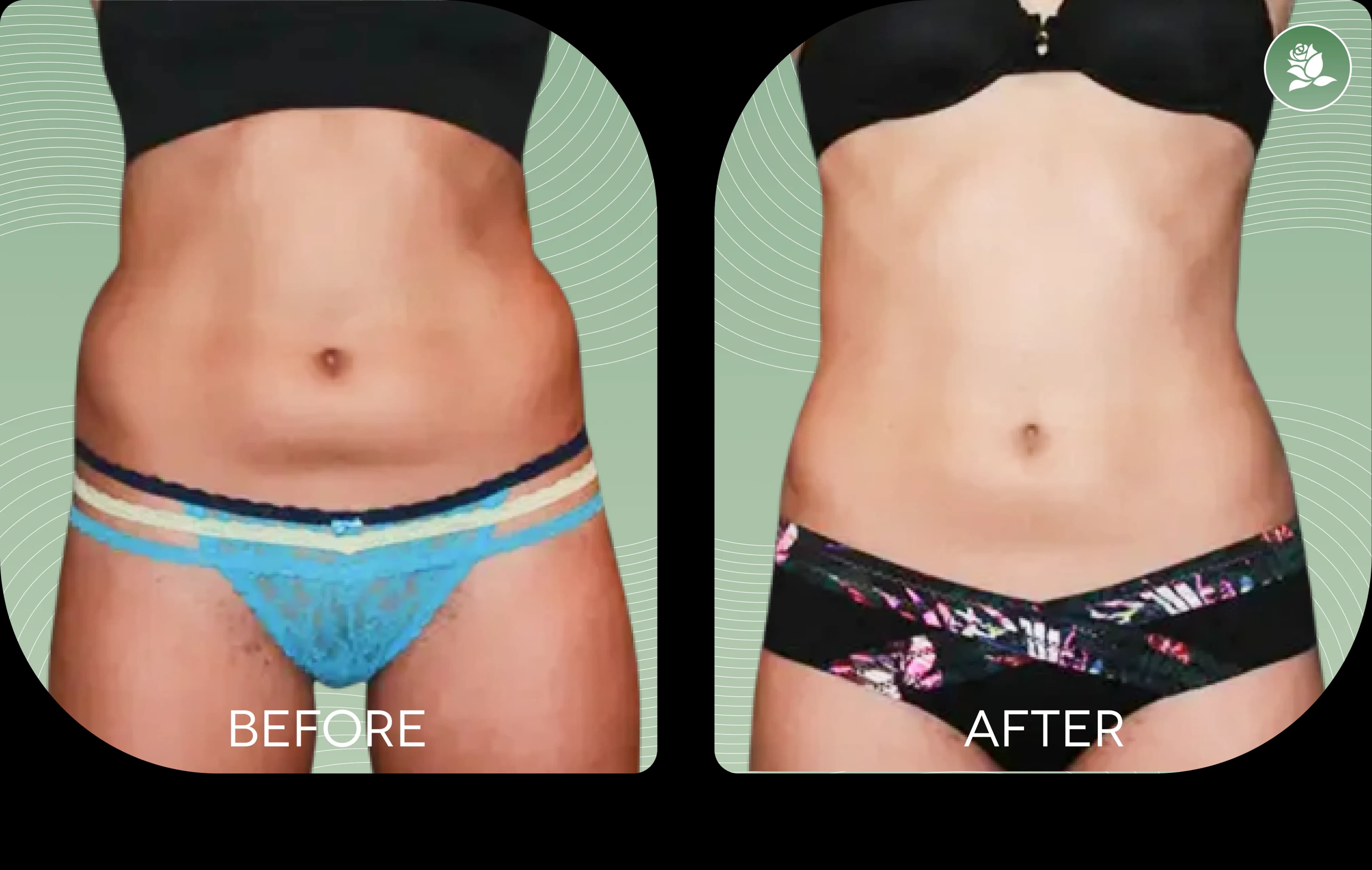 KRISTA MICALLEF before and after body contouring treatment
