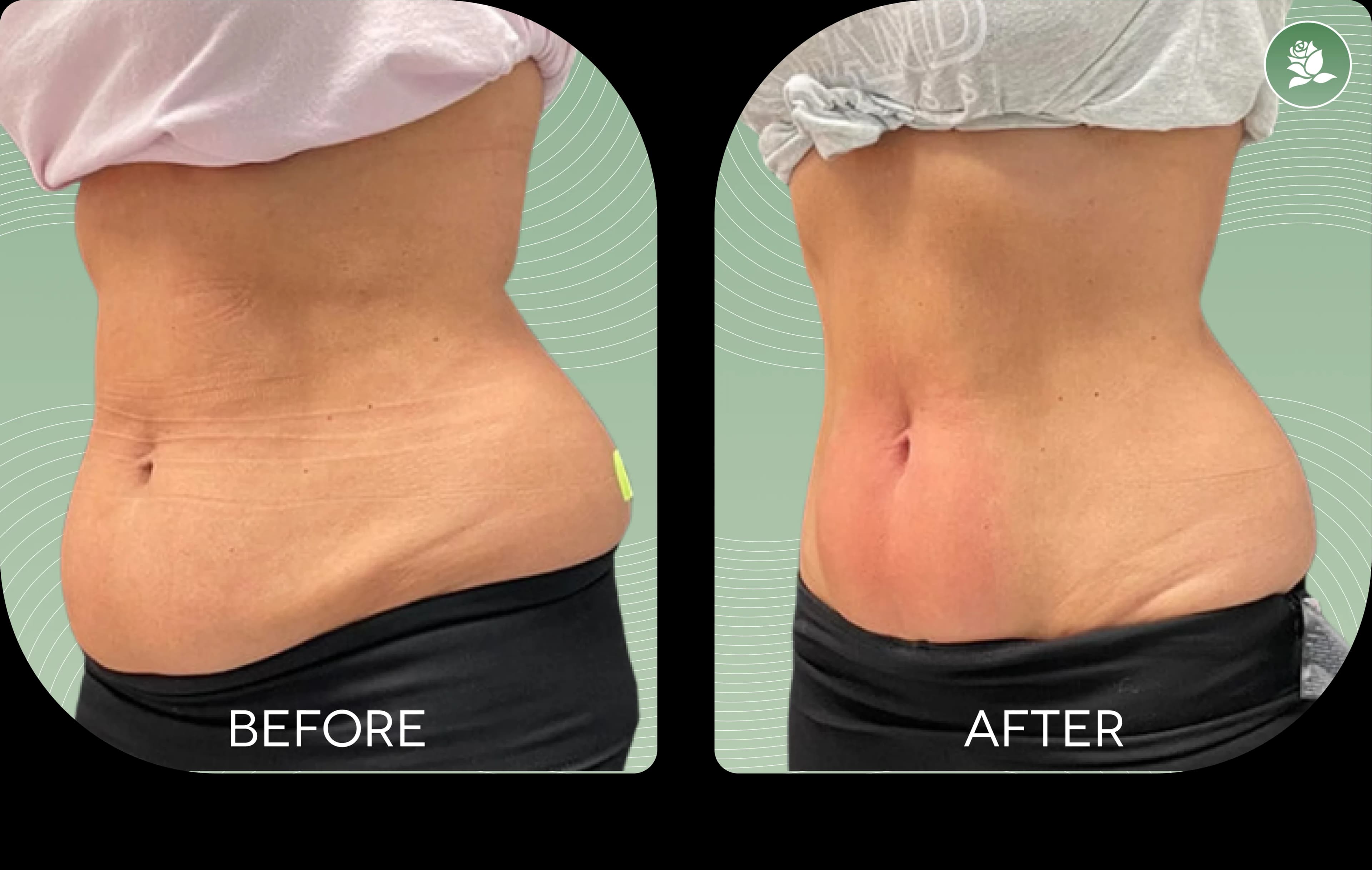 SOPHIA LORENT before and after body contouring treatment