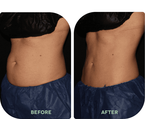 Before and after treatment result