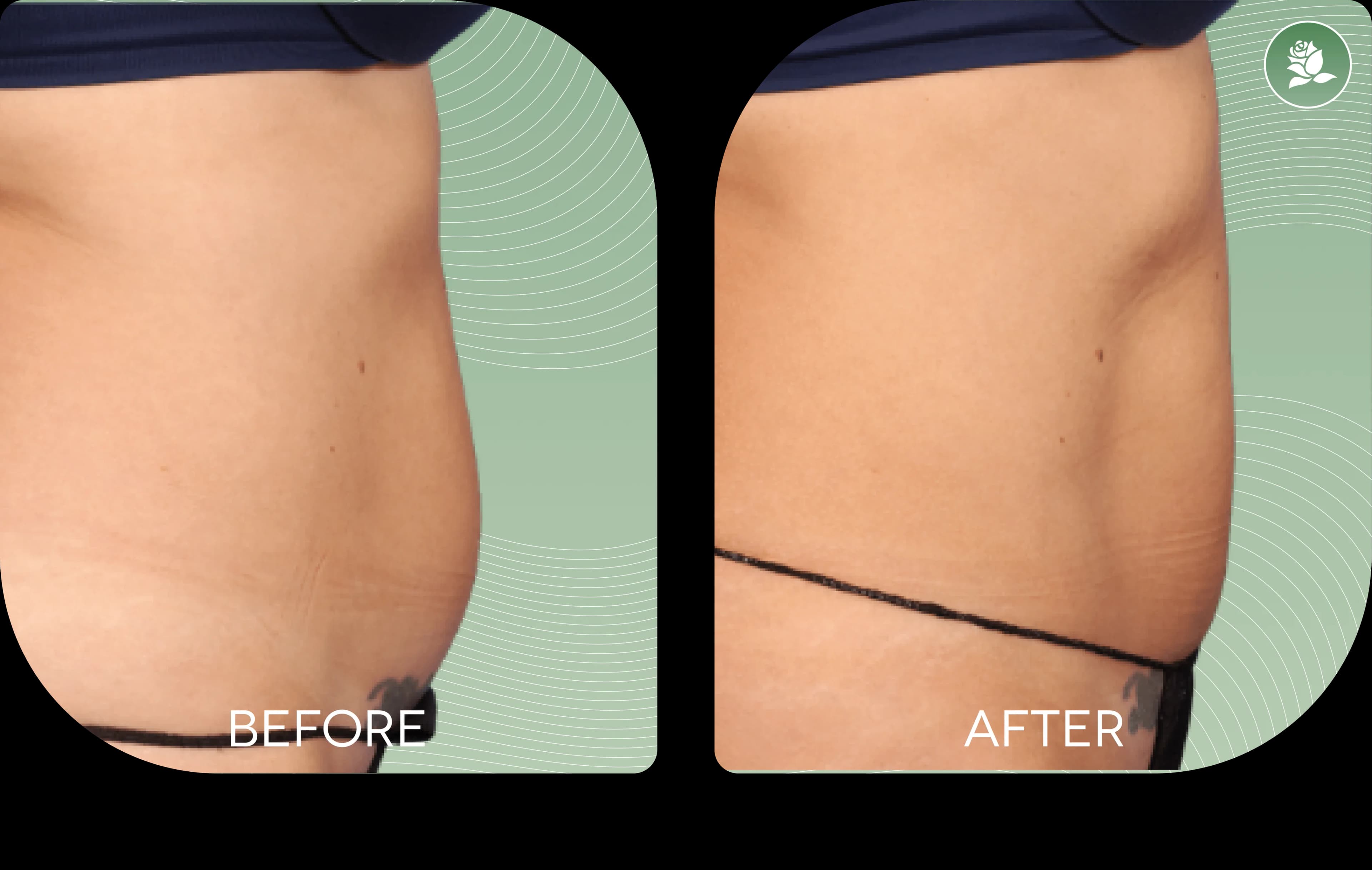 SARAH ATTARD before and after body contouring treatment