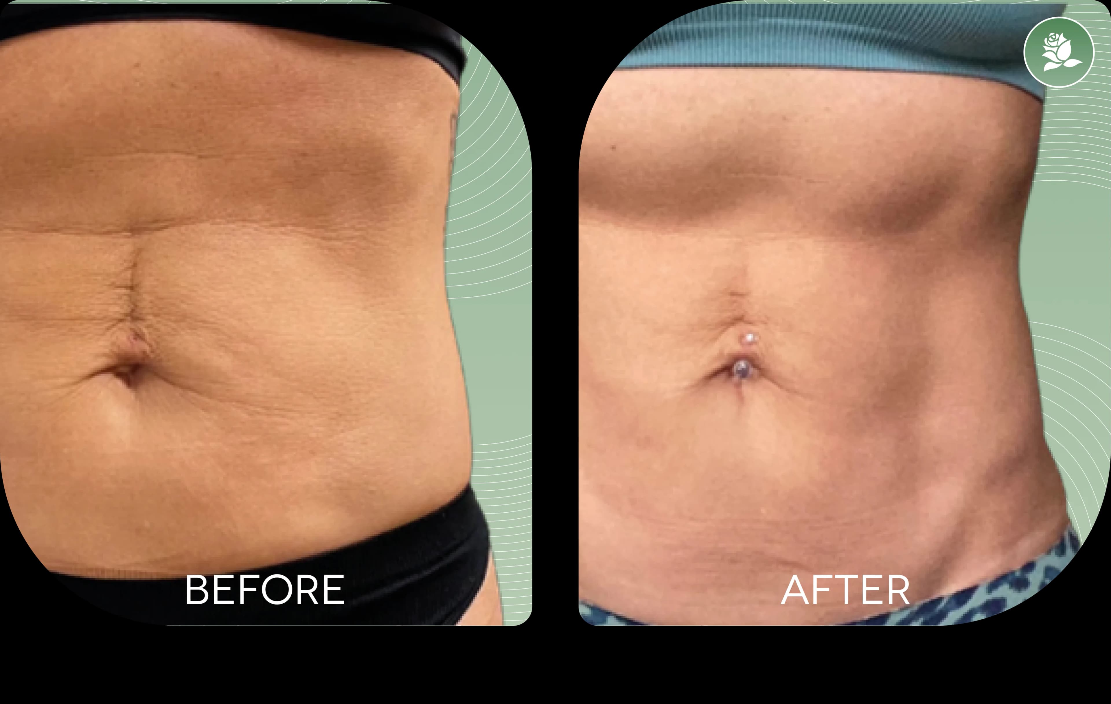 EMILY HART before and after body contouring treatment