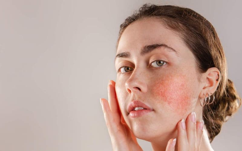 Discover 7 Safe and Effective Methods to Treat Sunburn