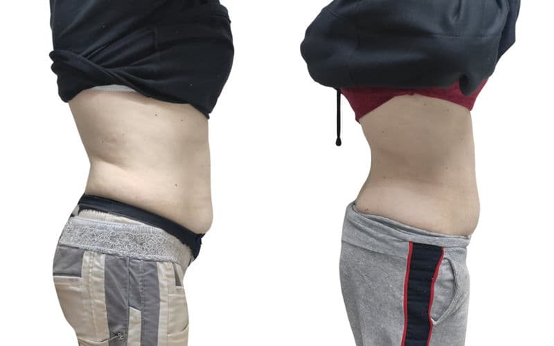 the ultimate guide to fat dissolving: what to expect