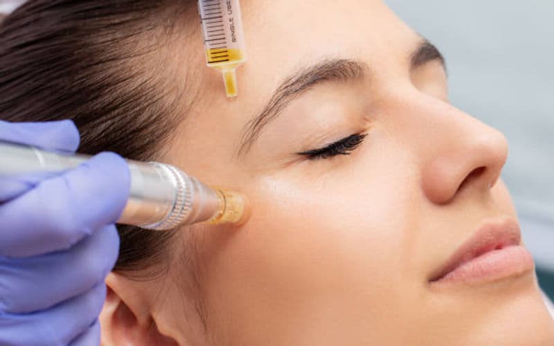 Why Microneedling Is the Skin Treatment You’ll Love This Valentine’s Day