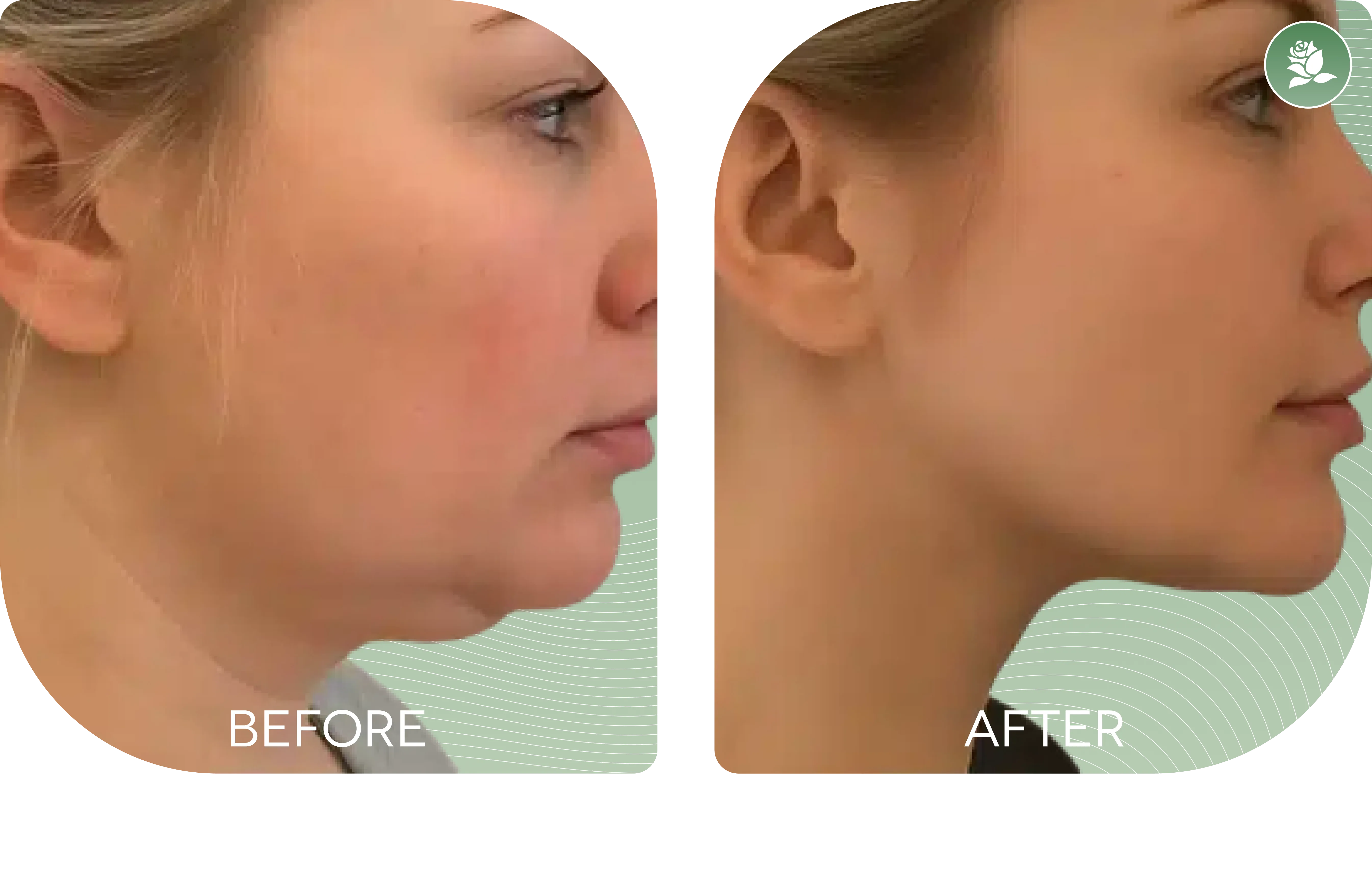 NICOLE ZAMMIT — before and after body contouring treatment