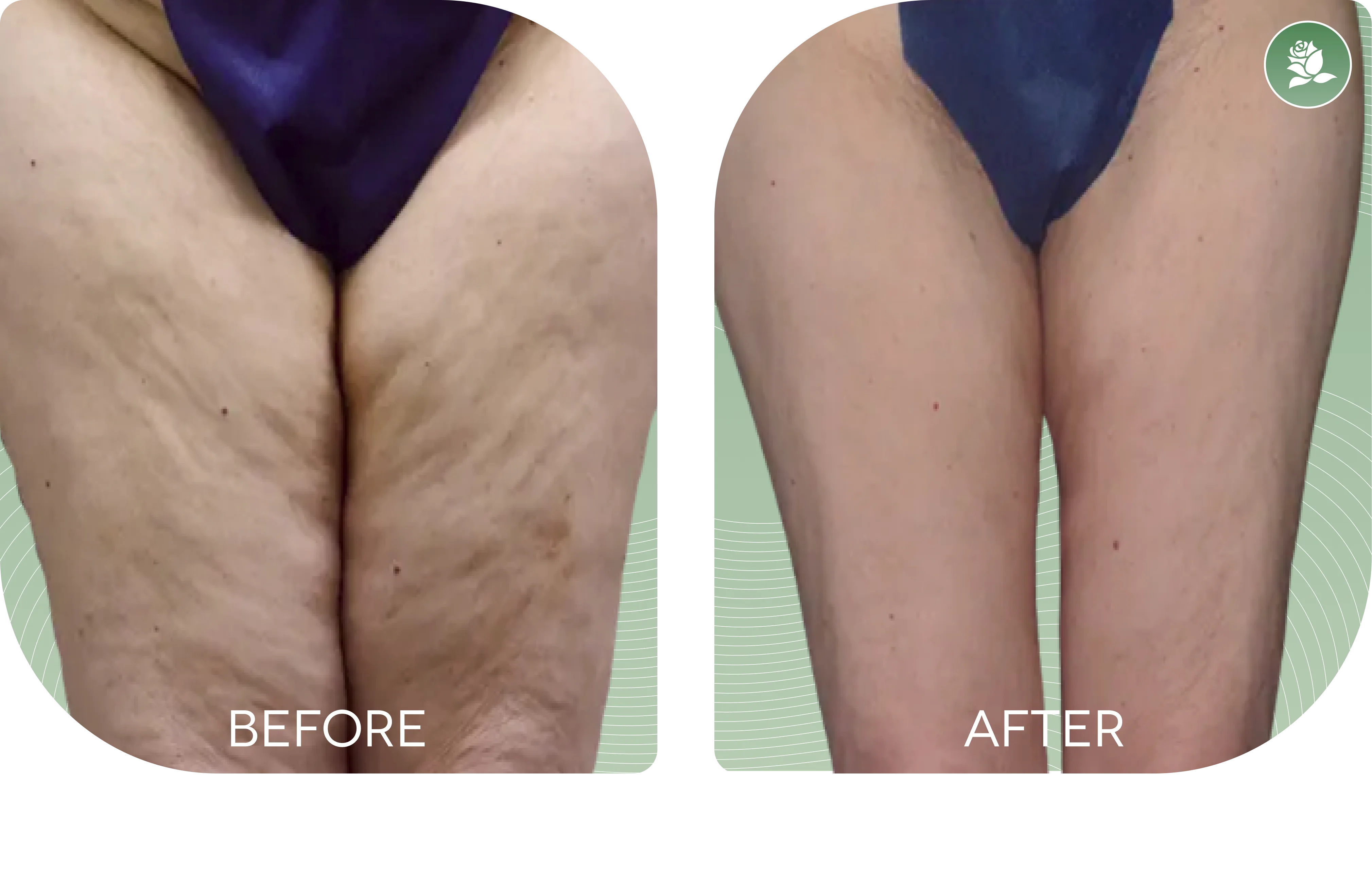 Stephanie A. — before and after body contouring treatment