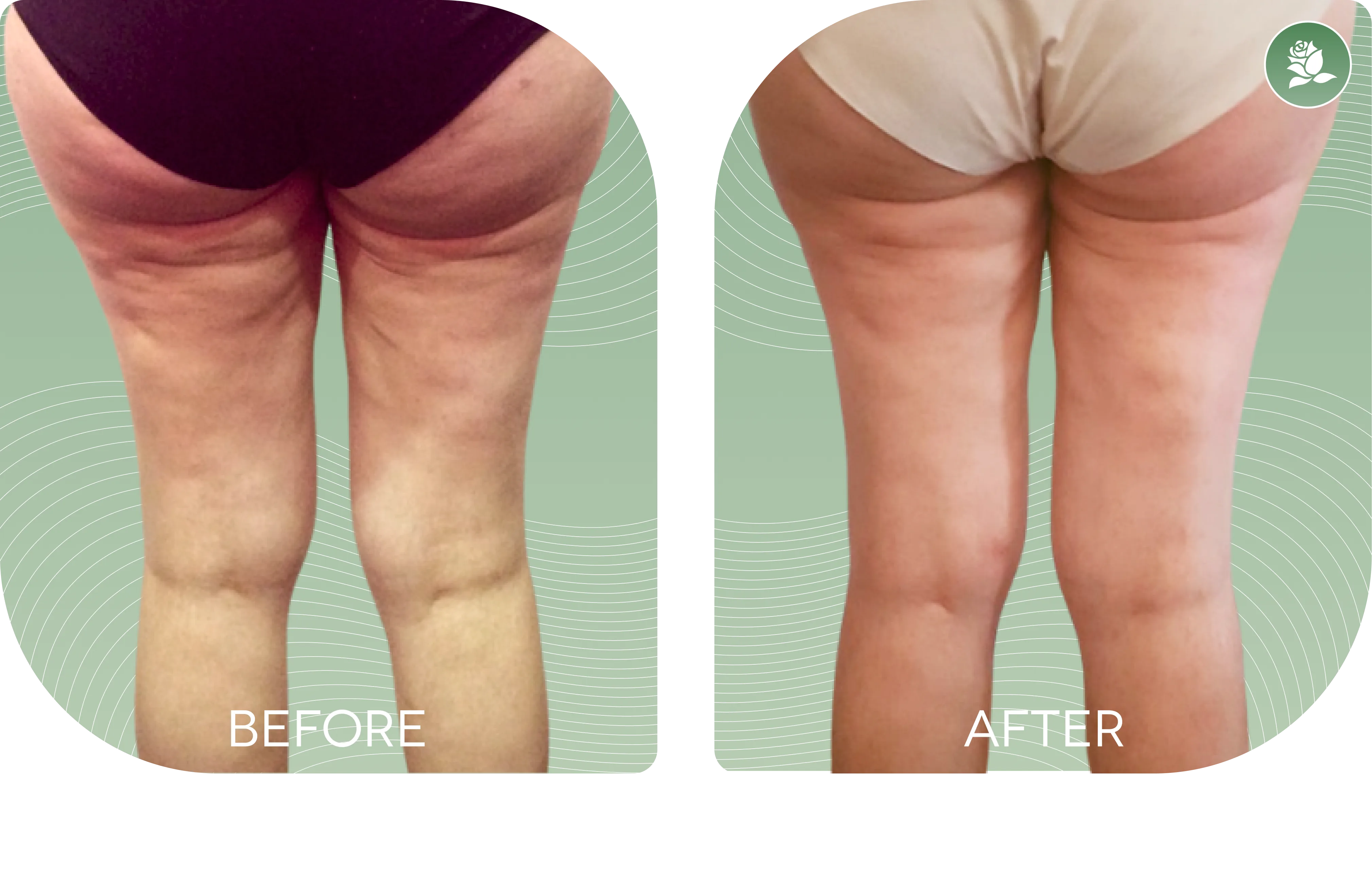 Francesca M. — before and after body contouring treatment