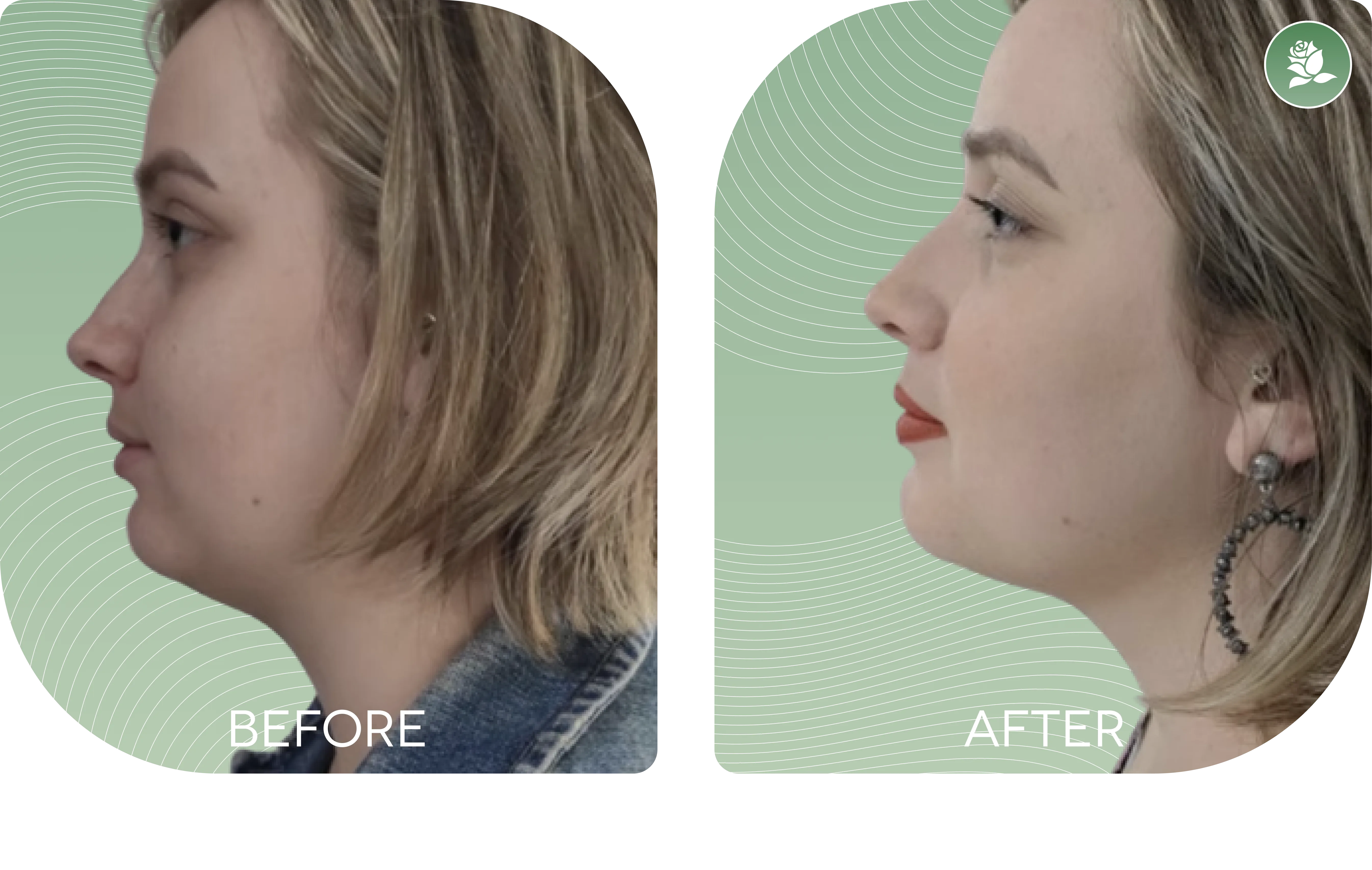 REBECCA ATTARD — before and after body contouring treatment