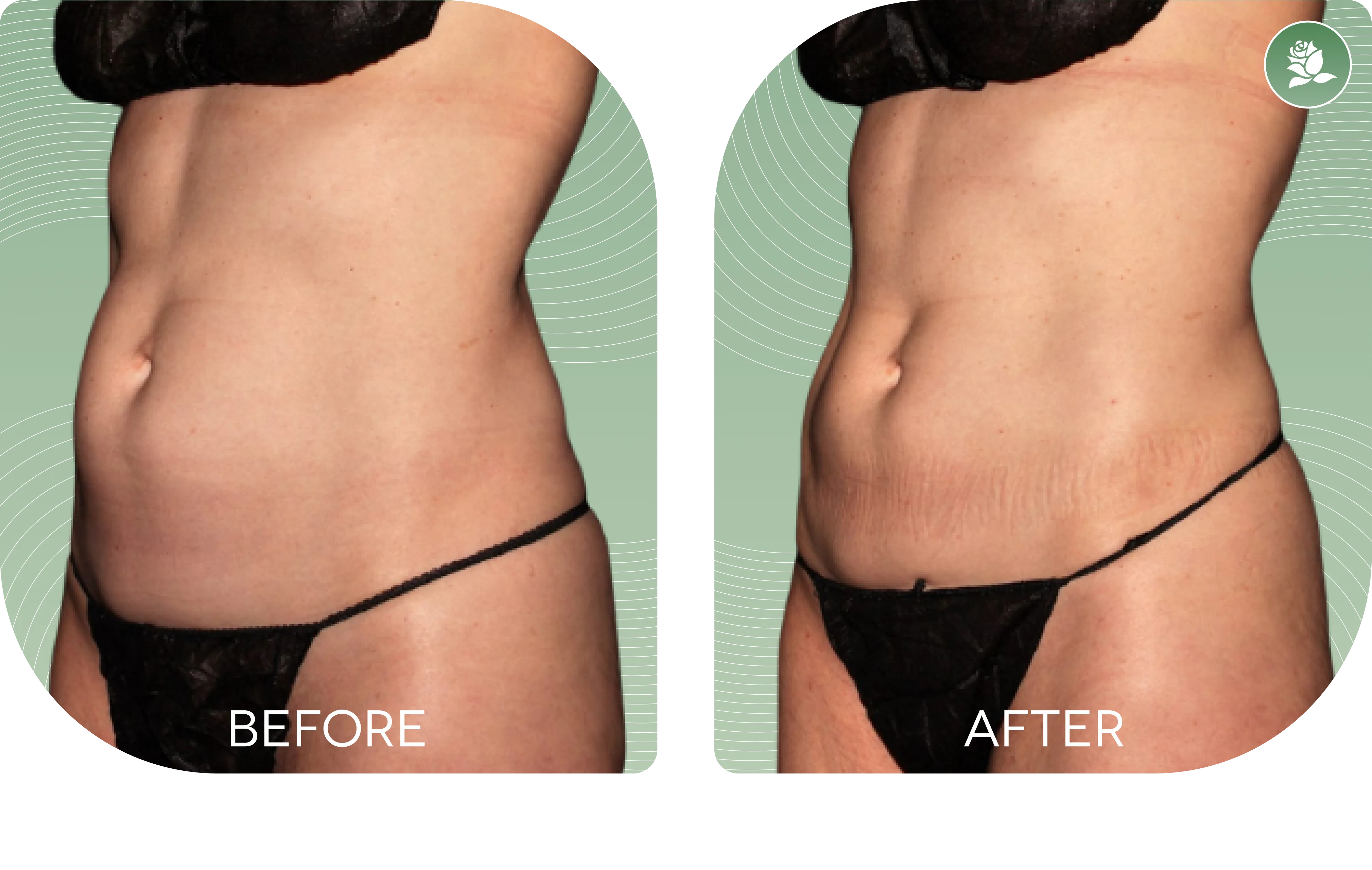 MARIJA CAMILLERI — before and after body contouring treatment