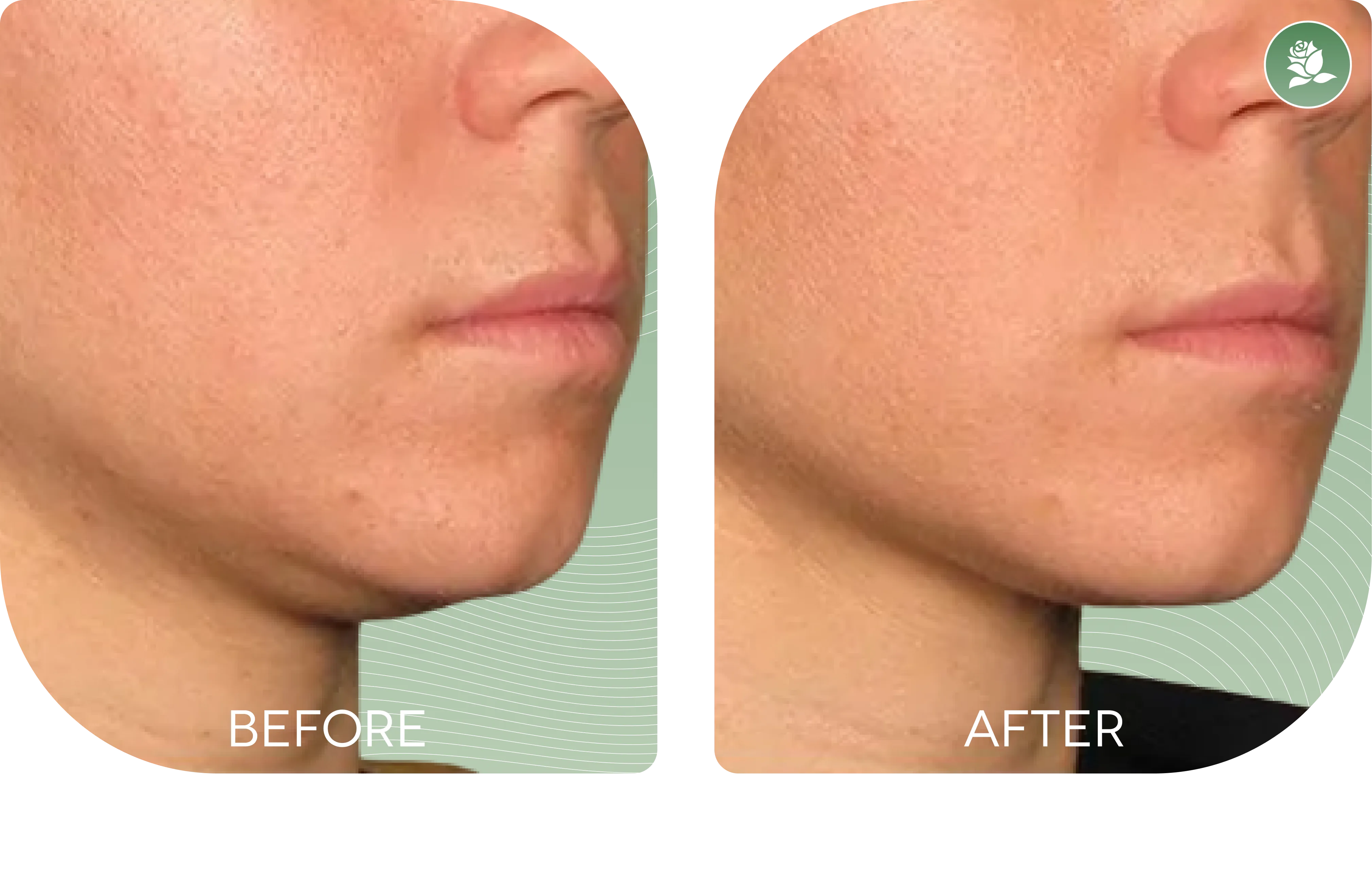 KRISTA MICALLEF — before and after body contouring treatment