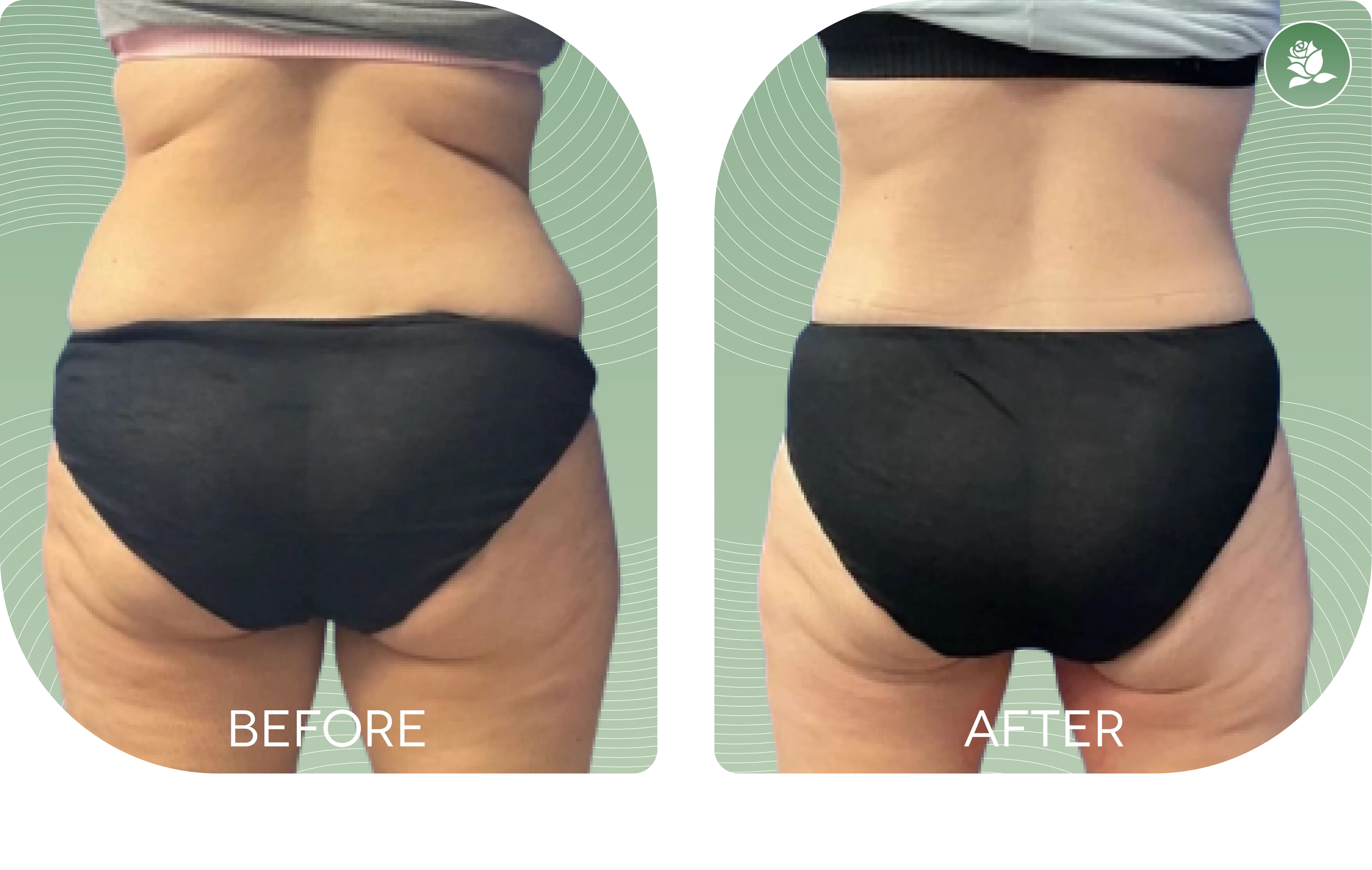REBECCA ATTARD — before and after body contouring treatment
