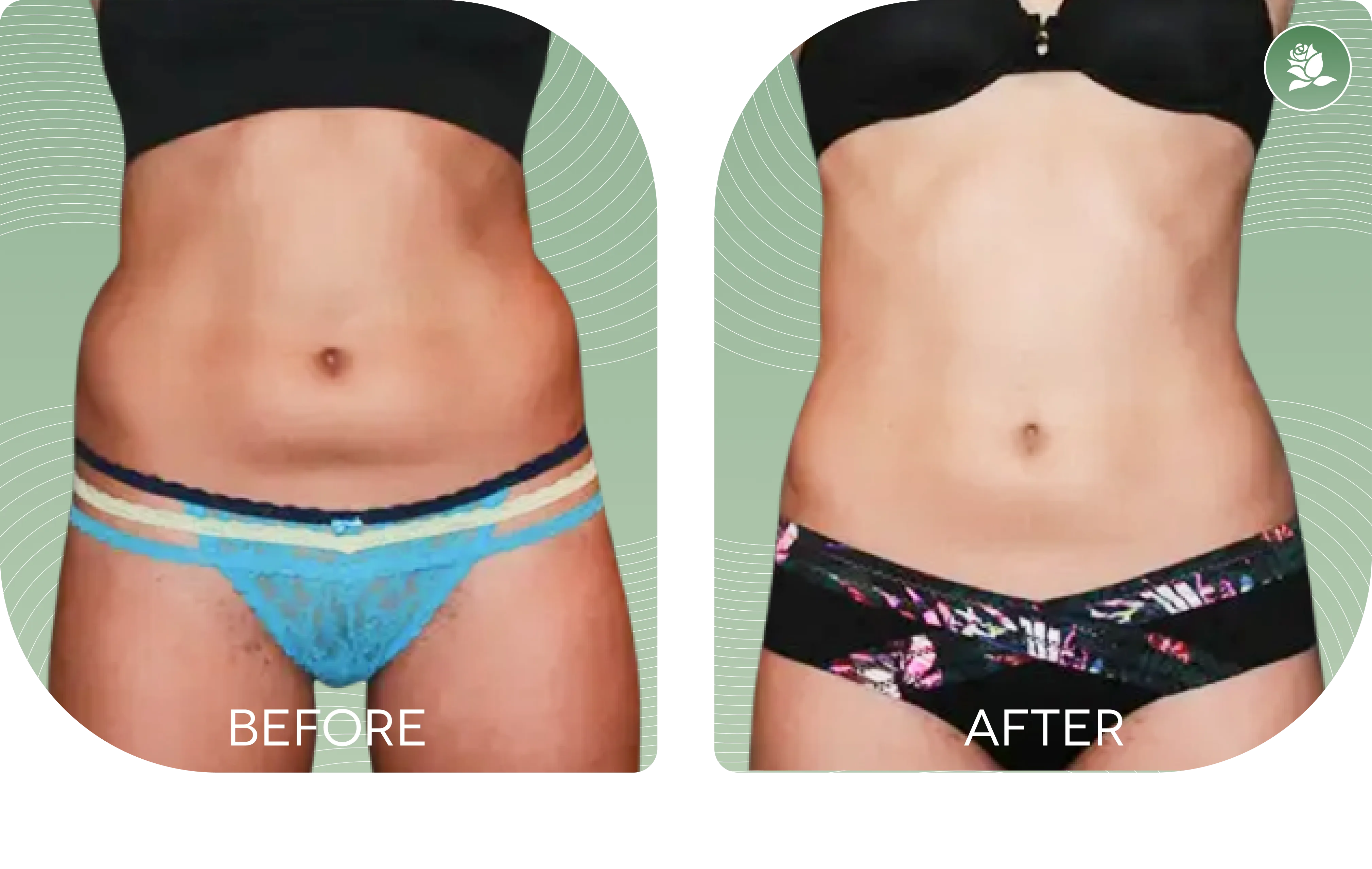 KRISTA MICALLEF — before and after body contouring treatment