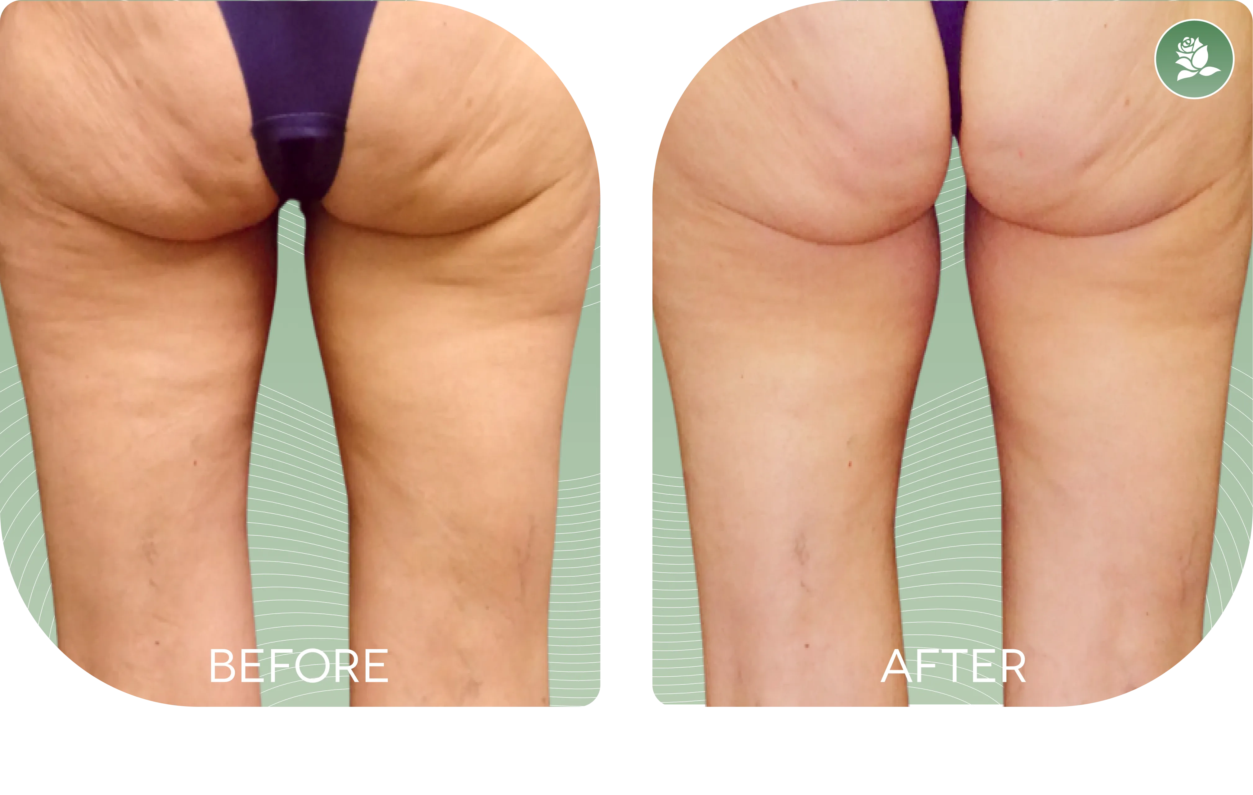 Daniela C. — before and after body contouring treatment